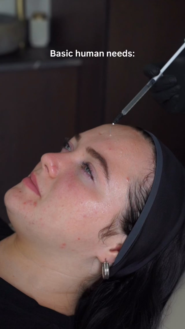 It’s basically a savings account for your face 🤝✨
Except instead of putting money away for future you, we’re banking collagen.
Microneedling creates controlled micro-injuries in the skin, encouraging your natural repair response and stimulating fresh collagen and elastin production. Think smoother texture, firmer-looking skin and that healthy glow we’re all chasing.
And collagen banking? It’s about investing in your skin before you feel like you need to “fix” it. Building and supporting collagen now can help maintain skin quality as natural collagen production gradually slows with age.
Future you will be very pleased you started. 🤌🏼
Want to know if microneedling is right for your skin? DM MICRONEEDLING to book a consultation. 🤍✨
TT Medical Clinic | Microneedling | Bridgend
