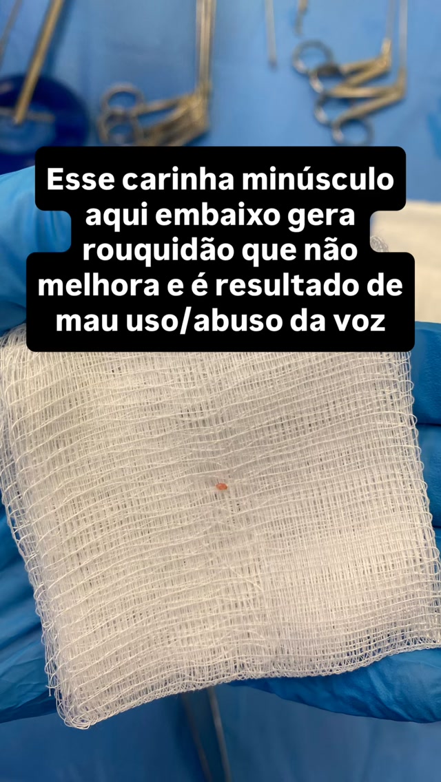 Rouquidão que não melhora em 2 semanas? Isso NÃO é normal. 🚨
A voz rouca até pode acontecer depois de um resfriado ou de gritar muito em um show — isso é normal e passa em poucos dias. O problema é quando a rouquidão persiste por mais de 2 semanas: aí é sinal de alerta e merece avaliação com otorrino especialista em voz.
Uma das causas mais comuns nesses casos é o pólipo de prega vocal 🎙️
📌 O que é e por que acontece:
É uma lesão benigna que se forma na prega vocal, geralmente causada por uso excessivo ou incorreto da voz, gritos, abuso vocal contínuo, associados ou não a fatores agressores como tabagismo e refluxo. Os pólipos são muito comuns em quem fala ou canta profissionalmente.
📌 Como se trata:
O tratamento combina cirurgia (fonomicrocirurgia de laringe, para retirar o pólipo com precisão) e fonoterapia, antes e depois da cirurgia, para reeducar o uso da voz e evitar que a lesão volte. Um tratamento não substitui o outro — eles trabalham juntos. Pólipos pequenos e de início recente podem melhorar sem cirurgia. Fonoterapia sempre.
⚠️ Ignorar a rouquidão persistente pode atrasar o diagnóstico e piorar a lesão. Sua voz é sua ferramenta de trabalho e de vida — cuide dela.
👉 Está rouco há mais de 2 semanas? Agende sua avaliação com um otorrino especialista em voz. Link na bio.
#rouquidao #laringologia #otorrino #polipovocal #fonoaudiologia