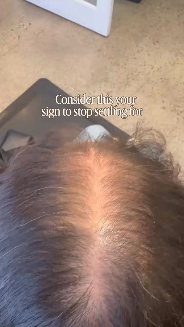 Curly hair + hair loss can make finding the right solution feel impossible. But THIS is what’s possible with the right customization. 👏
For this transformation, we used a CNC by @crlab_official to give her back the fullness she was missing while matching her natural curl pattern, texture and movement.
The blend? Completely seamless. You can’t even tell where her bio hair ends and her CNC begins (and that’s the whole point 😉)
And because her CNC stays securely attached, she can swim, shower, exercise, sleep and live her life without planning around her hair.
More hair. Same beautiful curls. A whole lot more freedom 🙌
Want this type of hair freedom? Call us to book a free consultation!
#hairloss #curlyhairproblems #hairlosssolutions #hairlosshelp #thinninghair