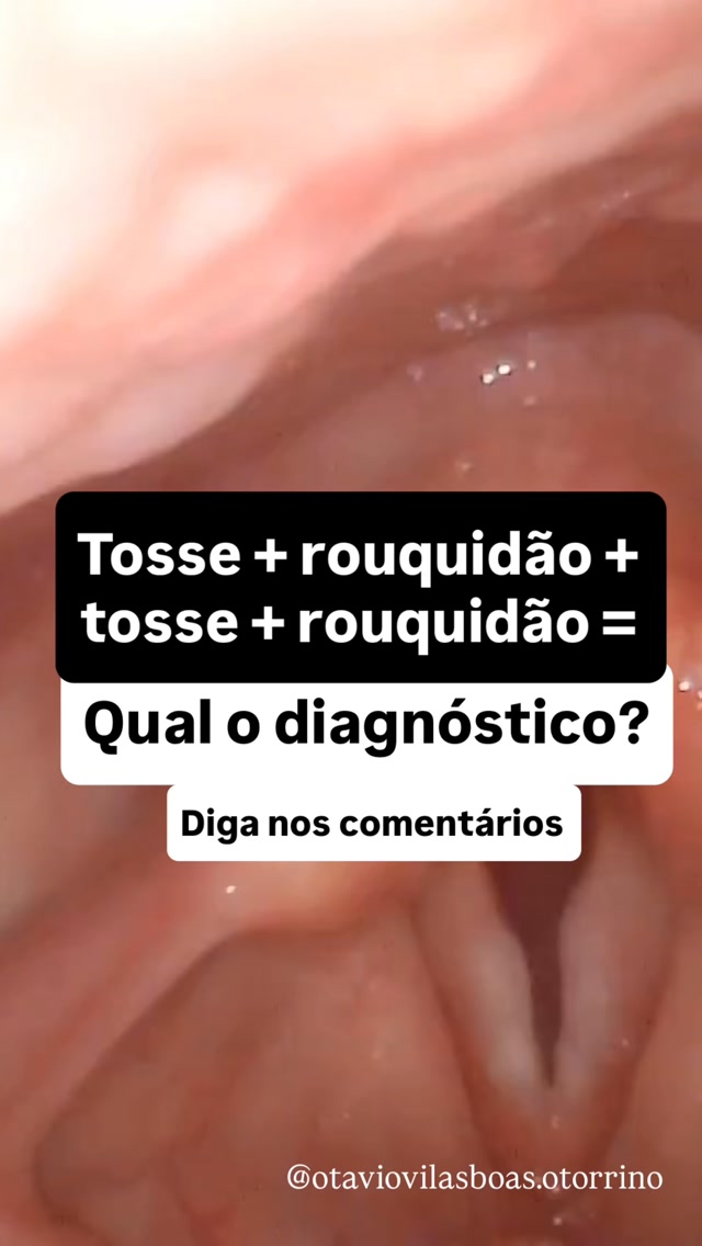 Um paciente previamente hígido, não tabagista, iniciou com quadro de tosse não produtiva, congestão nasal, gotejamento posterior, e evoluiu com disfonia. Os outros sintomas melhoraram mas permaneceu com disfonia e tosse por 30 dias, quando então passou em consulta. Naquele momento não apresentava mais nenhum outro sintoma.
Qual o provável diagnóstico?
#rouquidao #otorrino #fonoaudiologia #voz