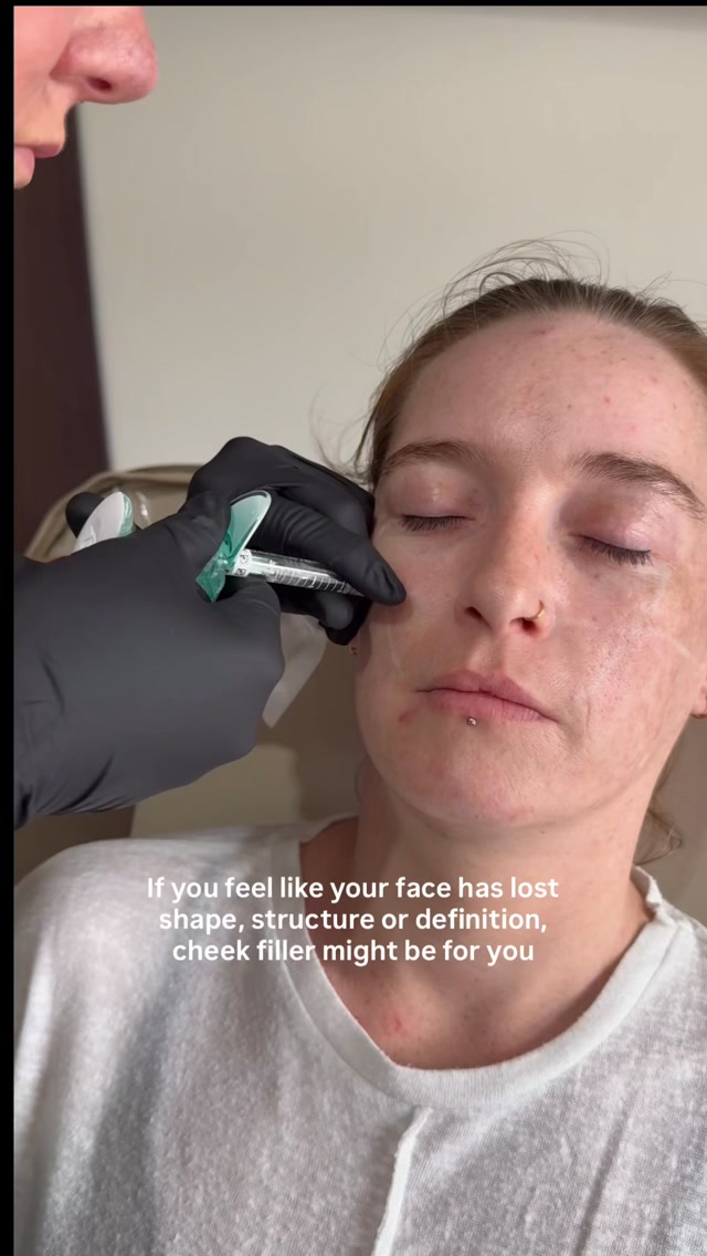 Cheek filler isn’t always about wanting “bigger cheeks.”
Sometimes it’s about restoring the structure that’s been lost over time, creating a little more support through the mid-face, or bringing back definition in a way that still looks completely like you.
Our filler expert, Nurse Beth, looks at your face as a whole before recommending any treatment, your proportions, movement, profile and where adding volume will actually make a difference.
No overfilling. No one-size-fits-all approach. Just carefully placed filler, when it’s needed, to create a result that feels balanced, subtle and natural. 🤍
If you feel like your face has lost a little shape, structure or definition, a consultation with Nurse Beth is the best place to start.