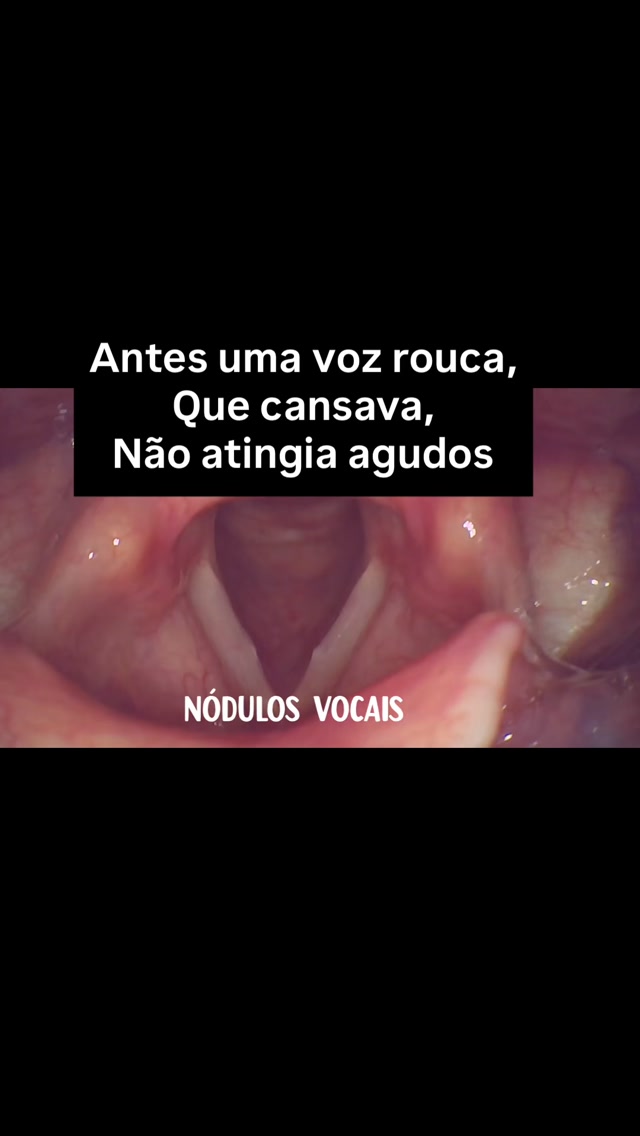 Rouquidão que não melhora precisa de avaliação especializada.
Neste caso vimos nódulos vocais que não tiveram melhora com o tratamento inicial, que é a fonoterapia.
Optamos por uma cirurgia para restaurar a voz dessa paciente. Depois do procedimento ela voltou a alcançar os agudos, teve melhora na qualidade da voz, cansa menos para falar. E, dedicada que é, continua seguindo as orientações do médico e da Fonoaudióloga.