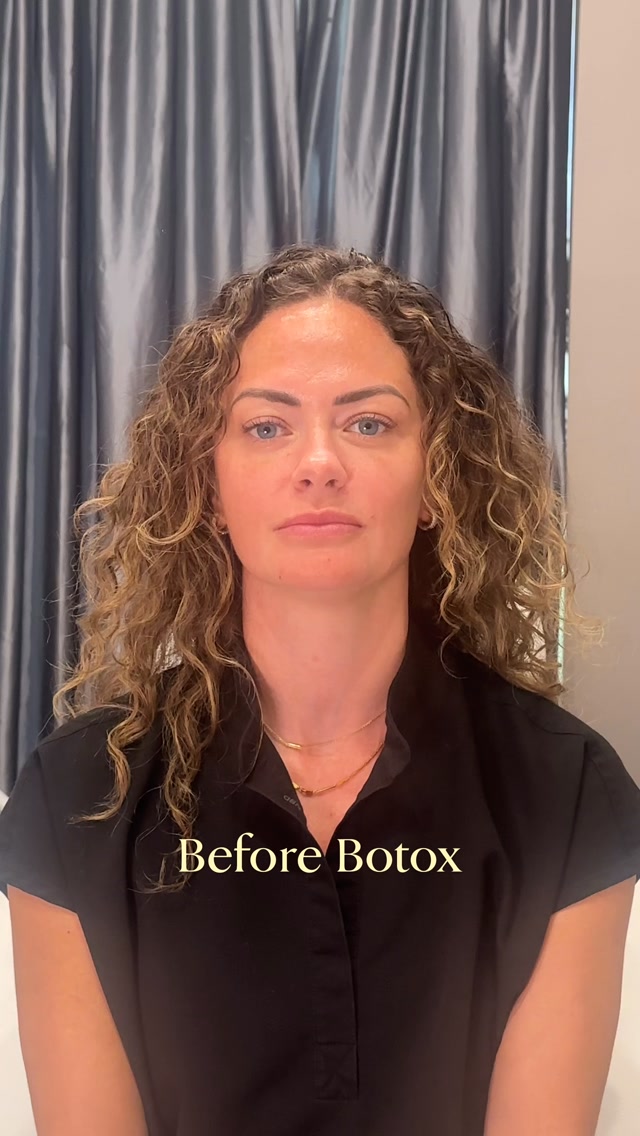 Still expressive, just subtly smooth where it counts 😍
My Botox and Juvederm lovers, I’ve got something special for you… Get $100 off your next @botoxcosmetic & @juvederm combo treatment at Lewisville Laser & Aesthetics 🎁 Offer is only valid while supplies last so call today to make your appointment and save!
Details:
- you must get your filler and tox treatment on the same day to be eligible for this offer
- All @juvederm products are eligible for offer except SkinVive
- 20 unit minimum for your tox treatment
- Limit 1 per customer
Call our office to schedule your next treatment! 📲🗓️
#botox #filler #medspa #winstonsalem