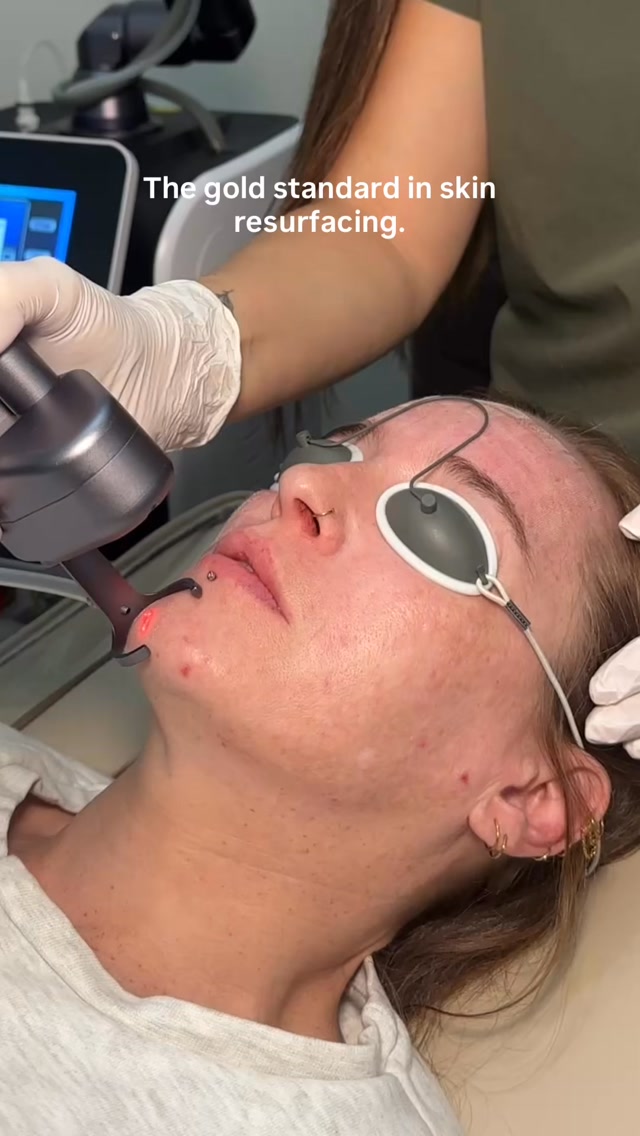 CO₂ laser season is officially here. ❄️✨
There’s a reason we love this treatment through the colder months. With less time spent in strong sun and a little more opportunity to hibernate while your skin recovers, winter is the perfect time to focus on deeper skin resurfacing.
CO₂ laser works by creating controlled micro-injuries in the skin, encouraging a natural repair response and fresh collagen production. It can be a brilliant option for improving:
✨ Fine lines + crepey texture
✨ Acne scarring
✨ Uneven skin tone + pigmentation
✨ Enlarged pores
✨ Overall skin texture + quality
This isn’t a “quick glow” treatment it’s for clients ready to invest in real skin change, with some expected redness, peeling and downtime along the way.
At TT Medical, we’ll assess your skin properly first and build a treatment plan around your concerns, skin type and goals. Because the best results always start with the right treatment for your skin. 🤍
Winter skin project pending… 👀
DM us CO2 to book your consultation or find out if resurfacing is suitable for you.