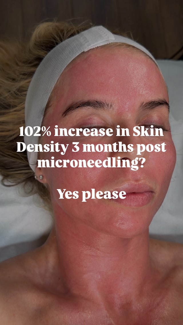 Microneedling has been shown to increase dermal density by over 100% after a course of treatments, helping rebuild the skin’s supportive structure from within 💖
Dermal density basically means how “dense” or substantial the dermis (the deeper layer of your skin) is.
Think of your dermis as the skin’s support structure. It contains:
* 🧬 Collagen for strength and firmness
* 🪢 Elastin for elasticity
* 💧 Glycosaminoglycans/hyaluronic acid for hydration and volume
* Blood vessels and other connective-tissue components
As we age, the dermis generally becomes thinner and less dense, partly because collagen production decreases and the existing collagen becomes fragmented, but 1-3 months after a course of Microneedling and there’s massive improvements in this 🙌🏽
The best way to keep the skin looking more plump and youthful for longer 🤍