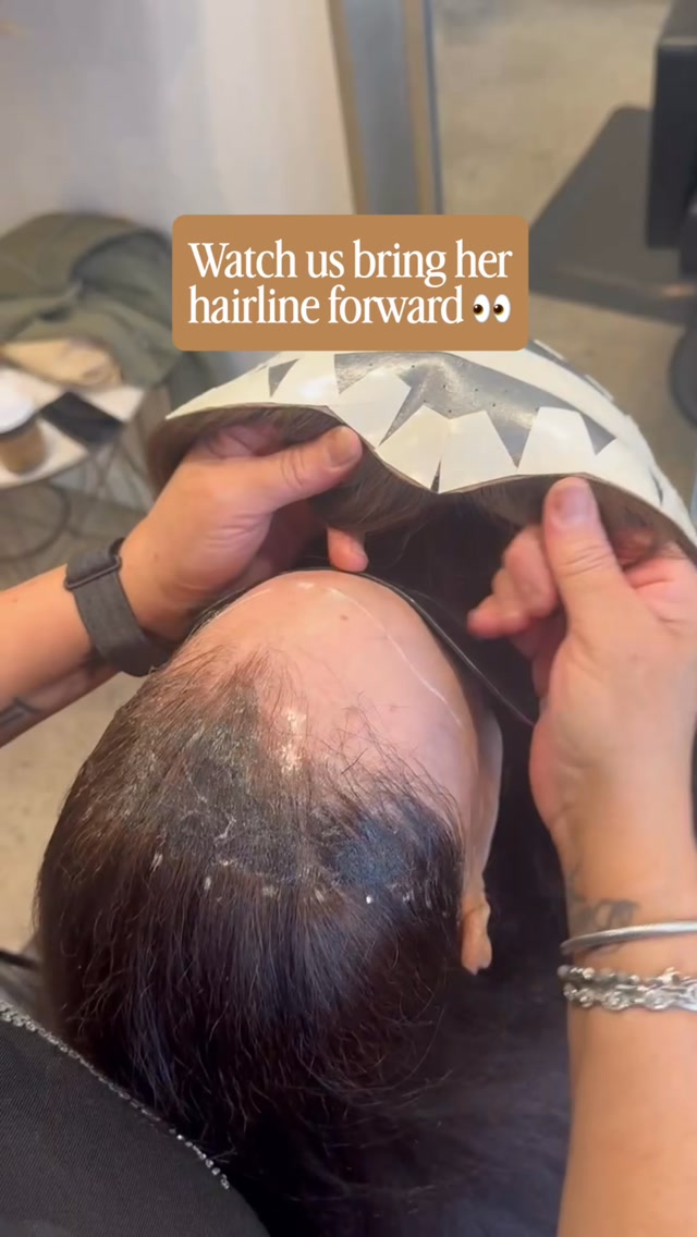 When frontal fibrosing alopecia starts to change your hairline, it can be hard to know what your options are.
Frontal fibrosing alopecia (FFA) is a type of hair loss that causes the hairline to gradually recede, often resulting in permanent hair loss in the affected areas.
For this client, the solution was a CNC by @crlab_official. 🤍
CNC is a fully customized, non-surgical hair replacement system designed to mimic the scalp and match your natural hair color, texture, density, and desired hairline.
For her, that meant bringing her hairline forward with a result that blends beautifully with her existing hair. ✨
Experiencing FFA or another form of hair loss? Book a consultation with us in Alamo or San Francisco to explore your options.
#ffa #frontalfibrosingalopecia #alopecia #hairlosssolutions #hairlosscommunity