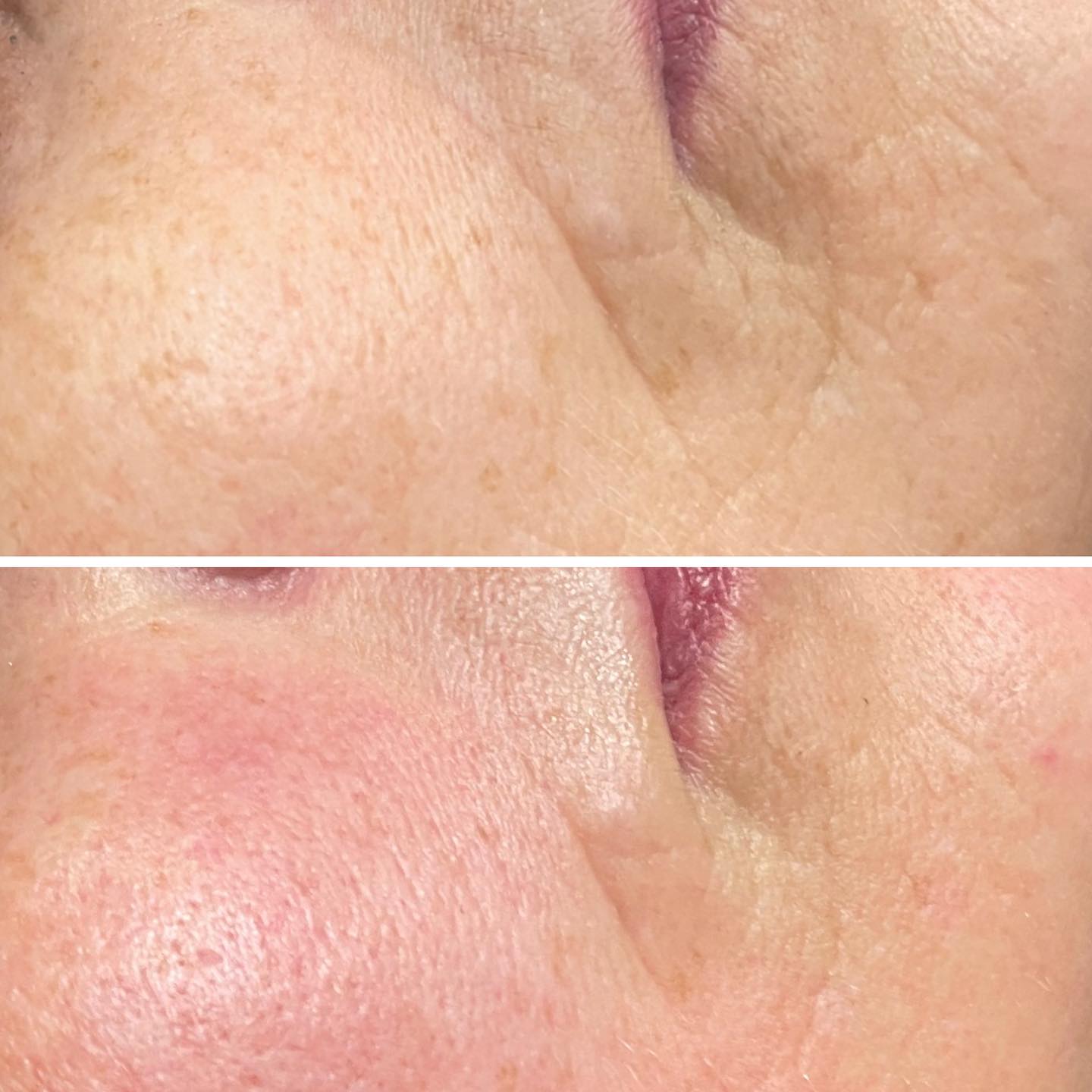 Just one Facial can improve lines and wrinkles we used @crystalclearskincare microdermabrasion followed by @caci_beauty jowl lift #skincare#antiageing#caci#crystalclearskincare#chesterfield#beautiquebarlborough