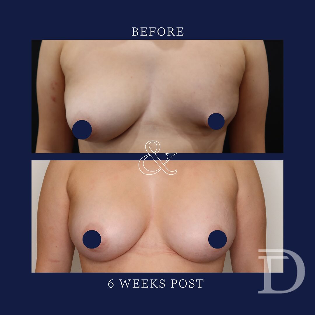 Breast Asymmetry Correction Surgery
1. Pre Surgery
2. 6 Weeks Post Insertion of Definitive Breast Implants
* This was a staged procedure - tissue expansion and fat grafting to the left breast, followed by bilateral insertion of implants 
  Surgery Performed by Dr Duncan Taylor (MED0001883464) Specialist Plastic & Reconstructive Surgeon.
🔹 Outcomes achieved in these photos are only relevant to this patient and do not necessarily reflect the results other patients may experience.
🔹There are inherent risks associated with any surgical or invasive procedures. The recovery period varies based on the specific procedure, and individual outcomes will differ.
🔹More information about risks and recovery for each procedure is available on our website www.drduncantaylor.com.au, on the procedure information sheets.
🔹We recommend getting a second opinion from a qualified health practitioner before proceeding.
🔹 This patient gave photo consent. 
#breastasymmetrycorrection #breastasymmetrysurgery #breastsurgeryperth #perthplasticsurgeon #plasticsurgeonperth #perthbreastaugmentation #breastaugmentationperth #breastimplantsperth #perthbreastimplants #fatgrafting #tissueexpander #perthplasticsurgery #plasticsurgeryperth #cosmeticsurgeryperth