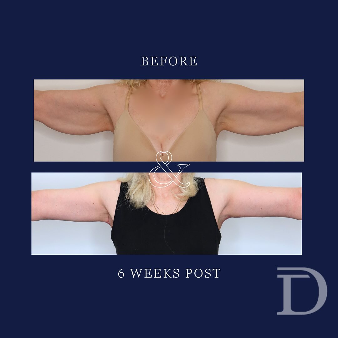Bilateral Upper Arm Liposuction + Brachioplasty (Arm Lift)  1. Before  2. 6 Weeks Post Op - Post surgical compression vest/ garment to be worn for 6 weeks post surgery.
Surgery Performed by Dr Duncan Taylor (MED0001883464) Specialist Plastic & Reconstructive Surgeon.
🔹 Outcomes achieved in these photos are only relevant to this patient and do not necessarily reflect the results other patients may experience.
🔹There are inherent risks associated with any surgical or invasive procedures. The recovery period varies based on the specific procedure, and individual outcomes will differ.
🔹More information about risks and recovery for each procedure is available on our website www.drduncantaylor.com.au, on the procedure information sheets.
🔹We recommend getting a second opinion from a qualified health practitioner before proceeding.
🔹 This patient gave photo consent. 
  #brachioplasty #armliftsurgery #armliftperth #brachioplastyperth #bodycontouringsurgery #perthbodycontouring #postweightlosssurgery #perthplasticsurgery #plasticsurgeryperth #cosmeticsurgeryperth #perthcosmeticsurgeon #specialistplasticsurgeon #plasticsurgeonperth #perthplasticsurgeon