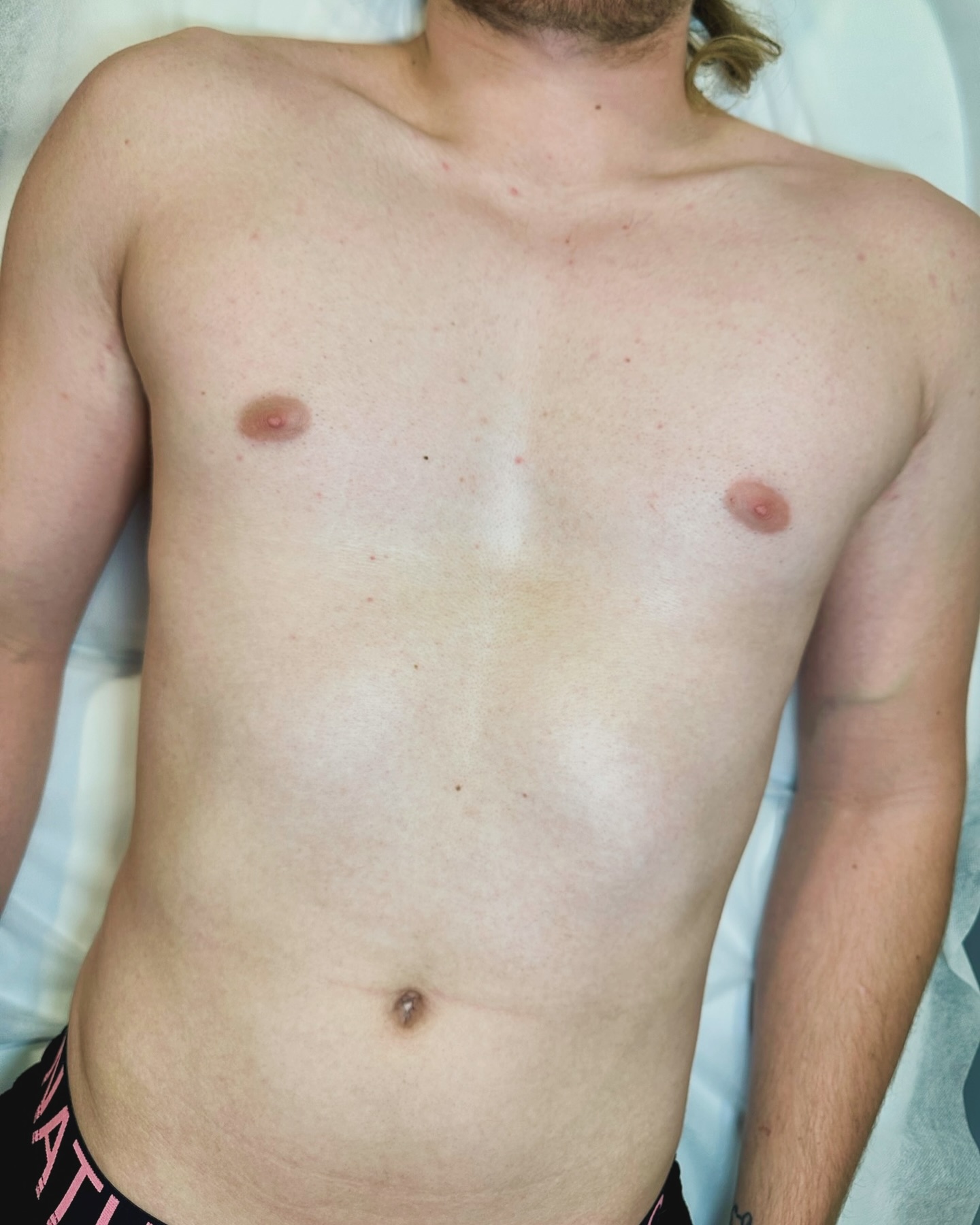 With summer coming to an end, now is the best time to start your laser journey! The most common area for our male clients is the chest/back. The results are quick & painless! ✨ #maleskincare #lhr #amityville #almasopranoiceplatinum #laserhairremovaltreatment #laserhairremoval @bornagainbeautifullyyou #skincare