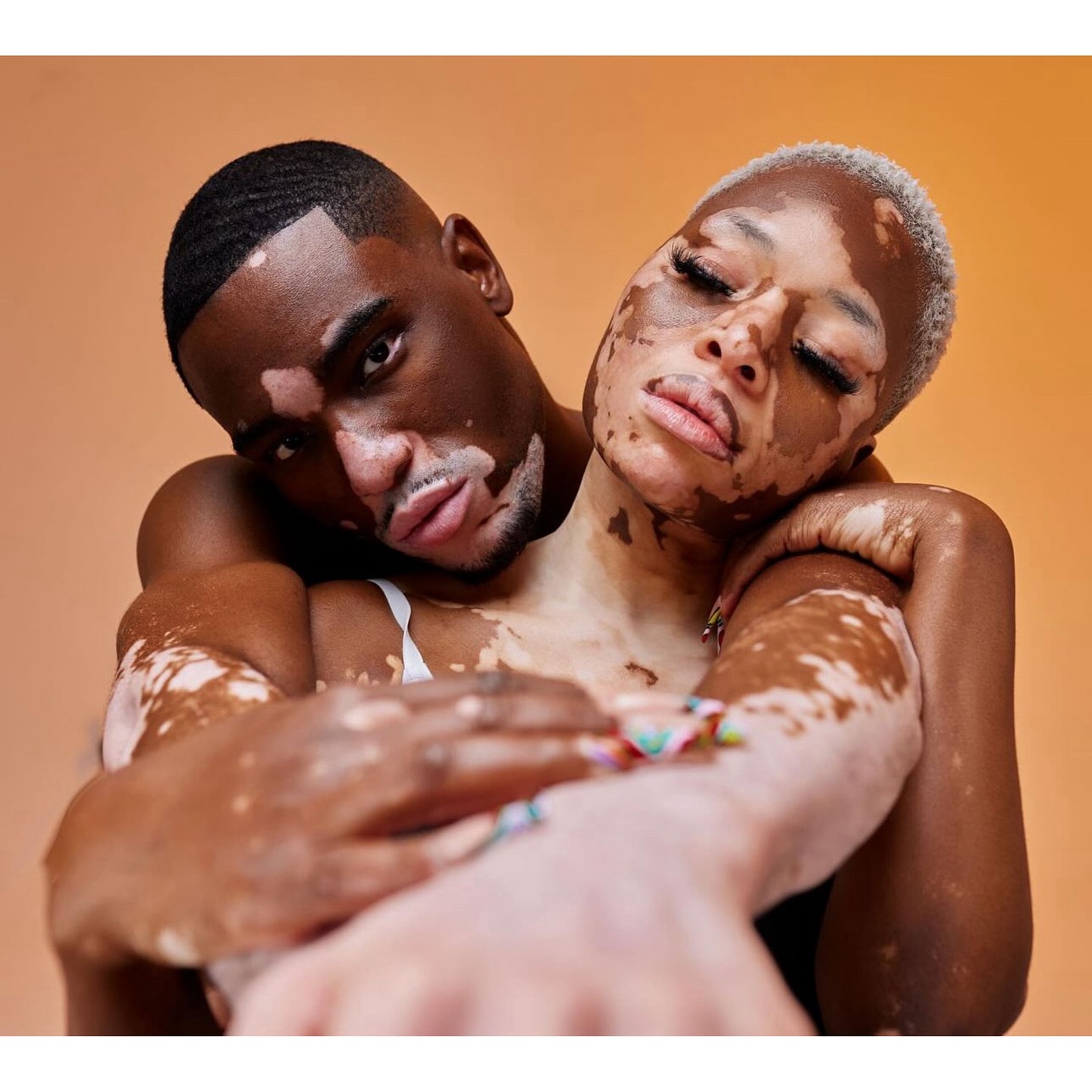 Just so stunning!😍🤩🔥
.
.
.
.
.
.
.
.
.
.
.
.
.
.
.
#vitiligo #visibledifference #birthmark #portwinestain #pws #keloid #moles #spots #scars #cmn #psoriasis #nevus #freckles #hemangioma #eczema #skindifferent #beautymark #unique #embraceyourself #selflove #diversity #selfconfidence #skinpositive #bodypositive #beautifulAsIam #normalizedifferent #normalizebirthmarks #birthmarkcommunity #beautifullyblemished