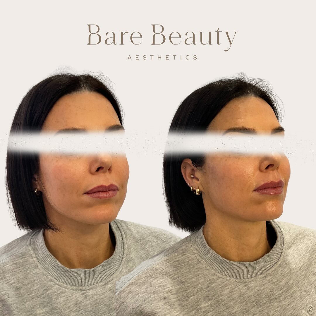 Cheek and lip enhancement 😍❤️
This stunning clients main concern was her lower face region. In particular her Nasolabial Folds (line we have from the sides of our nose to the corner of the mouth.)
After having an in depth consultation about her aesthetic goals. We decided to actually start her journey by restoring her volume loss in her lateral cheek region which will not only give her some support but it can also help soften her Nasolabial fold as well. Voila 🪄✨ can you believe that for her cheeks we only used 1 ml total😍 (0.5ml each side.) This is a clear example of how important placement of product really is! You can make stunning enhancement with minimal product.
She was also wanting to give her lips more hydrations and also a bit of voulume as well which is what we have achieved!
If you’ve been thinking about getting any injectable treatments, please feel free to book in a complimentary consultation (booking link in bio) or you’re more than welcome to flick me a private message where I will get back to you as soon as possible 😊
📍Located Taupo
Please Note: after photos taken directly after treatment. Photos shared with clients consent.
DISCLAIMER: Dermal Filler, Medical Device Class III to smooth facial wrinkles and folds, correct facial atrophic scars, restore or enhance the lips, or restore facial volume. Dermal filler has risk and benefits. Ask your doctor if dermal filler is right for you. For product information, check with your doctor or from product details with the supplier.
#cosmetics #cosmetinjectable #cosmeticnurse #aesthetics #aestheticnurse #antiaging #beauty #filler #injections #dermalfillers #neuromodulators #skincare #wrinkles #finelines #antiwrinkle #facialesthetics #ilovetaupo #womenempowerment #selfcare #booknow #consultation #linkinbio