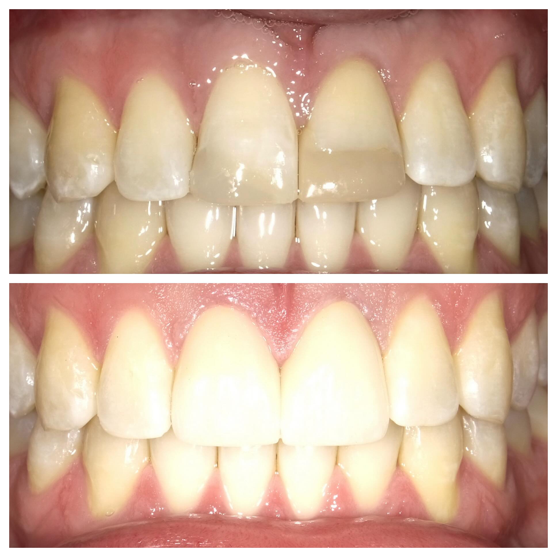 Wish I had the patient lick his teeth for the bottom photo, but nonetheless, we have a young male in his early 30s who just finish Invisalign. We had him bleach for a couple weeks after removing his attachments and crowned his front two teeth. Patient couldn’t be happier! #crowns#teethwhitening#invisalign
