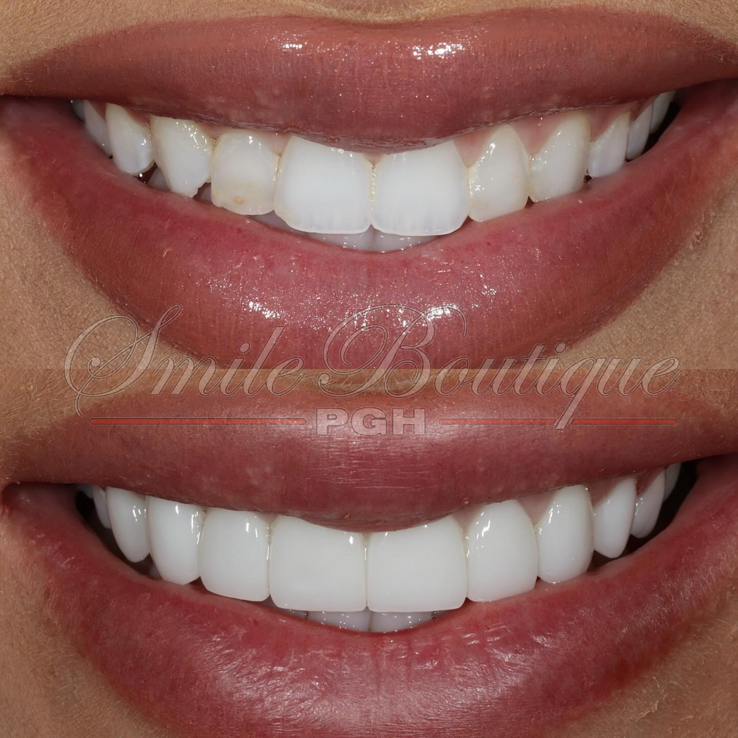 Throwback Thursdays 💫
What a perfect smile, a case I transformed 2 years ago, to re-feature today! 1st, what a beautiful smile and secondly, it’s her birthday! @breraymond didn’t like many aspects of her smile, but the two main issues were lack of symmetry and her front teeth jumped out so here’s what I did:
☑️ Created symmetry
☑️ Permanently brightened smile
☑️ Widened her smile in the back
☑️ Strenghten teeth
☑️ Rejuvenated smile
☑️ Straightened smile
Procedures:
1️⃣ Gingivoplasty (laser gum lift)
2️⃣ 9 Lithium Disilicate veneers
End result = a gorgeous smile 🤩
HAPPY BIRTHDAY Bre and can’t get enough of your smile!
FUN FACT: Bre followed us from the very beginning and always wanted her smile done. She was so nervous about the process and what her results would look like that she had three of her family members come to me first before she proceeded with her own transformation 😆
#throwback #tbt #feature #anotherone #smile #smilemore #treatyoself #smiletransformation #smilemakeover #happyclient #happypatient #anothersatisfiedcustomer #wow #wowsmile #happy #amazing #cosmeticdentistry #cosmeticdentist #aacddentist #smiledesign #masterceramist #greatresults #outofthisworld #traveling #luxurylifestyle #milliondollarsmile #pittsburgh #pittsburghdentist #topdentist #whosnext