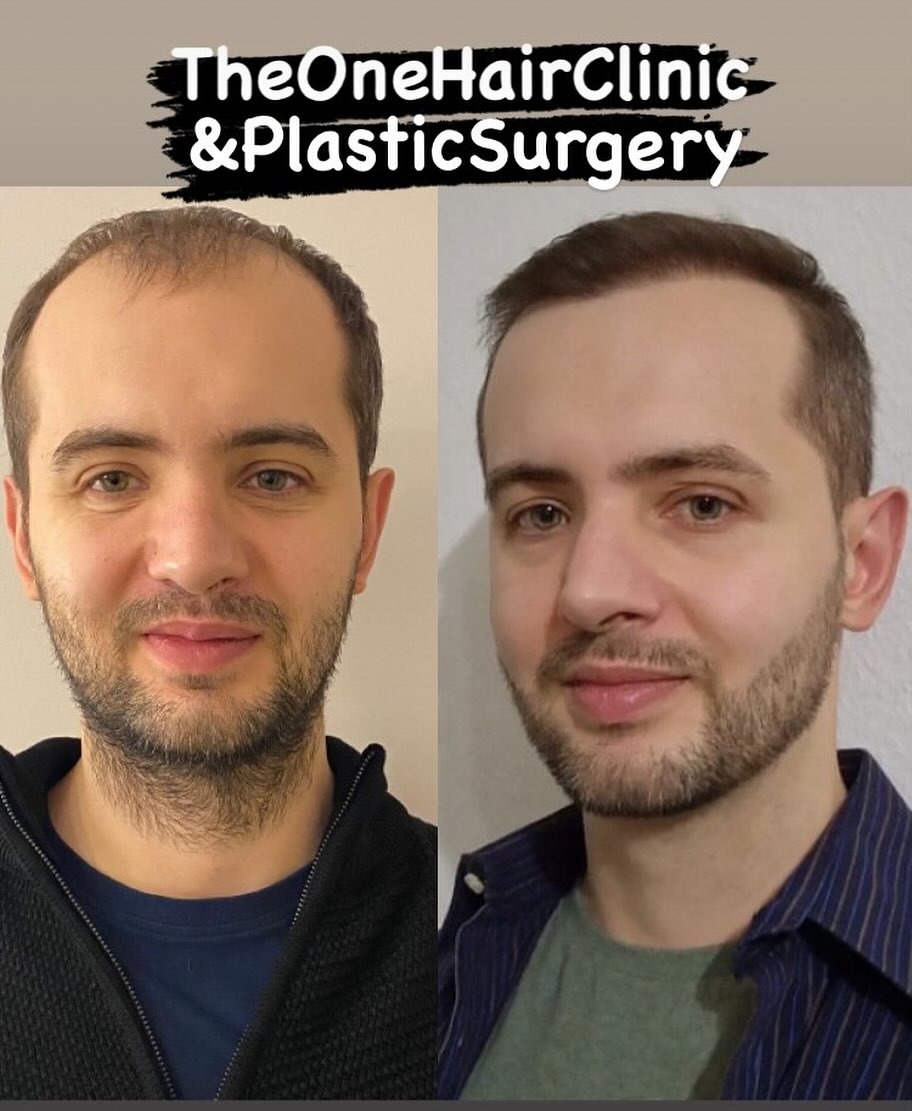 #hair #haartransplantation #prptreatments #stamzellenbehandlung #afteroneyear #happypatients #theonehairclinicandplasticsurgery #