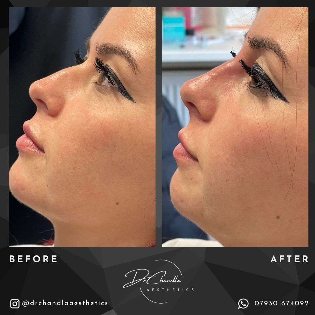 Non-surgical rhinoplasty: A natural enhancement
This model had filler injected to straighten her nose and to give the tip of the nose a lift. The filler used was Relife Definisse Core.
Want to learn more about non-surgical rhinoplasty? Contact Dr Chandla Aesthetics or book a consultation.
Dr Chandla Aesthetics is a Doctor Led Medical Aesthetics Clinic.
WhatsApp: 07930674092
Email: info@drchandlaaesthetics.co.uk
www.drchandlaaesthetics.co.uk
#nonsurgicalrhinoplasty #rhinoplasty #nosejob #liquidnosejob #dermalfillers #cosmeticprocedure #facialenhancement #beforeandafter #nonsurgicalrhinoplastybirmingham #nonsurgicalrhinoplastysolihull #nonsurgicalrhinoplastywestbromwich #aesthetics #aestheticspractitioner #aestheticsdoctor