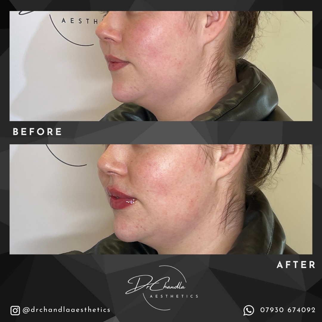 Enhance your smile.
This one is from the Lip Filler Model Day. This lady had previously been treated by us. After being happy with the result, she booked in to have her lips enhanced. This was done using the lollipop technique 🍭 with Relife Definisse Touch.
Ready to enhance your pout? Contact Dr Chandla Aesthetics or book a consultation today!
Don't forget that we are offering 20% off all treatments booked online during October using the code OCTOBER20.
Dr Chandla Aesthetics is a Doctor Led Medical Aesthetics Clinic.
WhatsApp: 07930674092
Email: info@drchandlaaesthetics.co.uk
www.drchandlaaesthetics.co.uk
#lipfiller #lipfillerbirmingham #lipfillersolihull #lipfillerwestbromwich #lips #lipinjections #fullerlips #pout #lipgoals #dermalfillers #cosmeticprocedure #facialenhancement #beforeandafter #aesthetics #aestheticsbirmingham #aestheticssolihull #aestheticswestbromwich #aestheticspractitioner #aestheticsdoctor