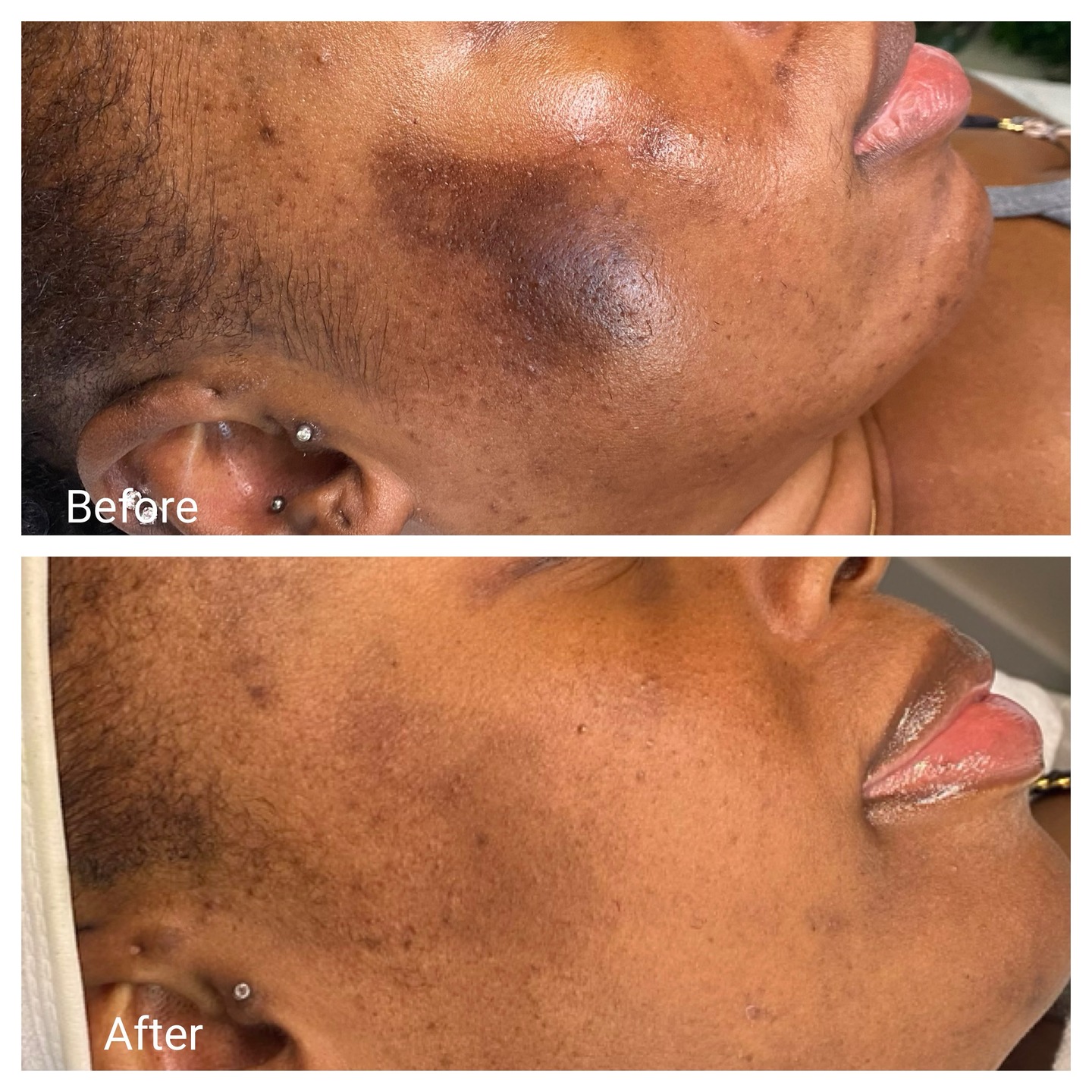 Another awesome result from using our A’Unique Skin Resurfacing Night Treatment Serum. 🙌🏽🙌🏽
Using it is just as effective as getting a chemical peel. Say farewell to dullness as lactic and glycolic acids resurface your skin, leaving it noticeably brighter and more even-toned. This beauty used it as a spot treatment to reverse the large patch of hyperpigmentation from her skin.
#aestheticallyunique #aestheticallyunique💋 #facials #oilyskin #deepporecleansing #hyperpigmentation #browardesthetician #ftlauderdaleesthetician #coralspringsesthetician #broward #coralsprings #ftlauderdale #tamarac #esthetician #parkland #miami #northlauderdale #boca #women #men #microneedling #love #instapic #skincare #skincareroutine #skincareproducts #skincaretips #selfcare #glowingskin #antiaging