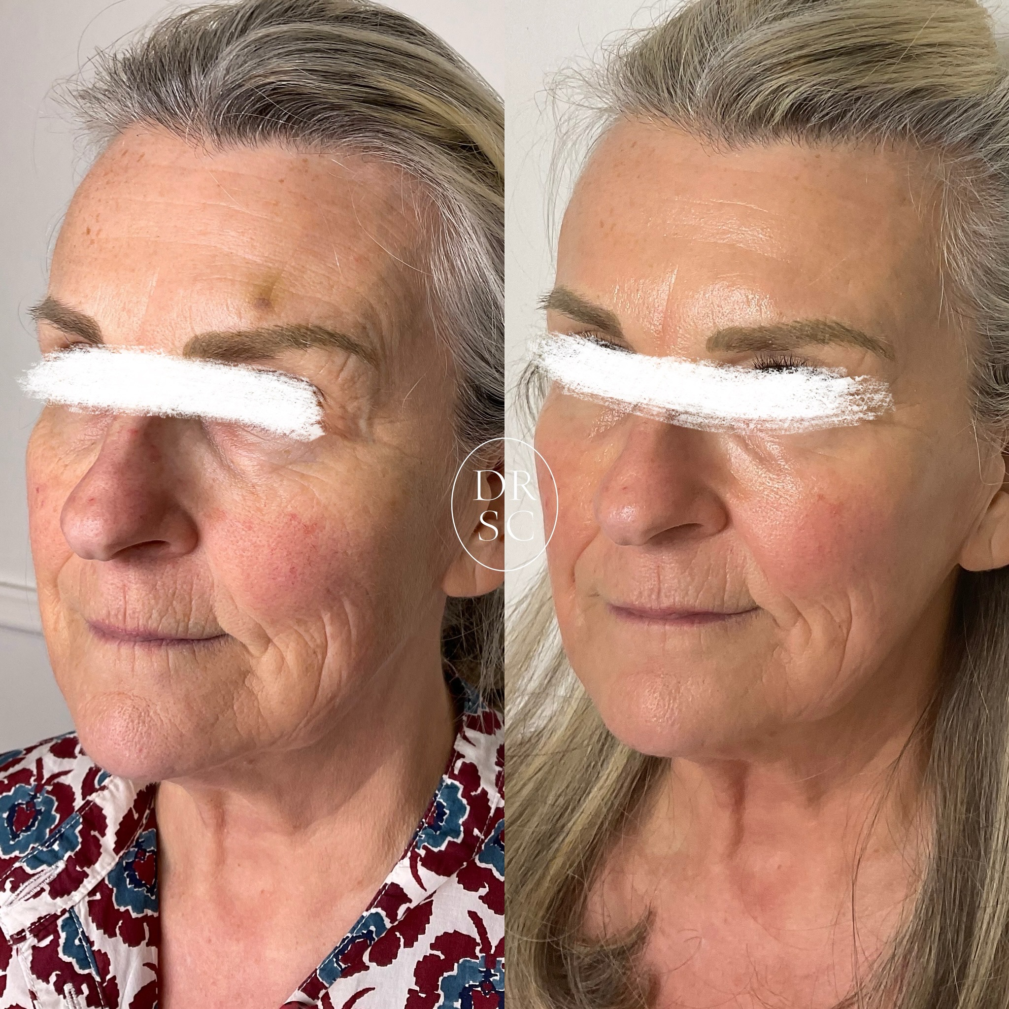Before & After 3 weeks with, Artemis Star 🌟
One session of our powerful hybrid winter therapy that involves 3 incredible technologies: Radiofrequency Microneedling & Ablative Fractional Laser.
Beautiful for skin quality, glow and soft tightening.
Downtime: 5-10 days, skin prep essential.
This is our Mother-Of-The-Bride Beauty regime! We had 3 weeks to get this very nervous MOTB & Aesthetic treatment virgin ready for the wedding. I’m so grateful she trusted me! She didn’t want surgery or fillers. From here a little bit of volume replacement will be a beautiful next step. Often, smiling in a before and after picture makes wrinkles look more pronounced but here she looks spectacular and that’s why I love energy based devices.
Appointments with Dr Cardoso call 0214244257 or WhatsApp 0815881186
#laser #laserfacial #motherofthebride #skincare #beauty #skinprep #capetowndoctor #botox