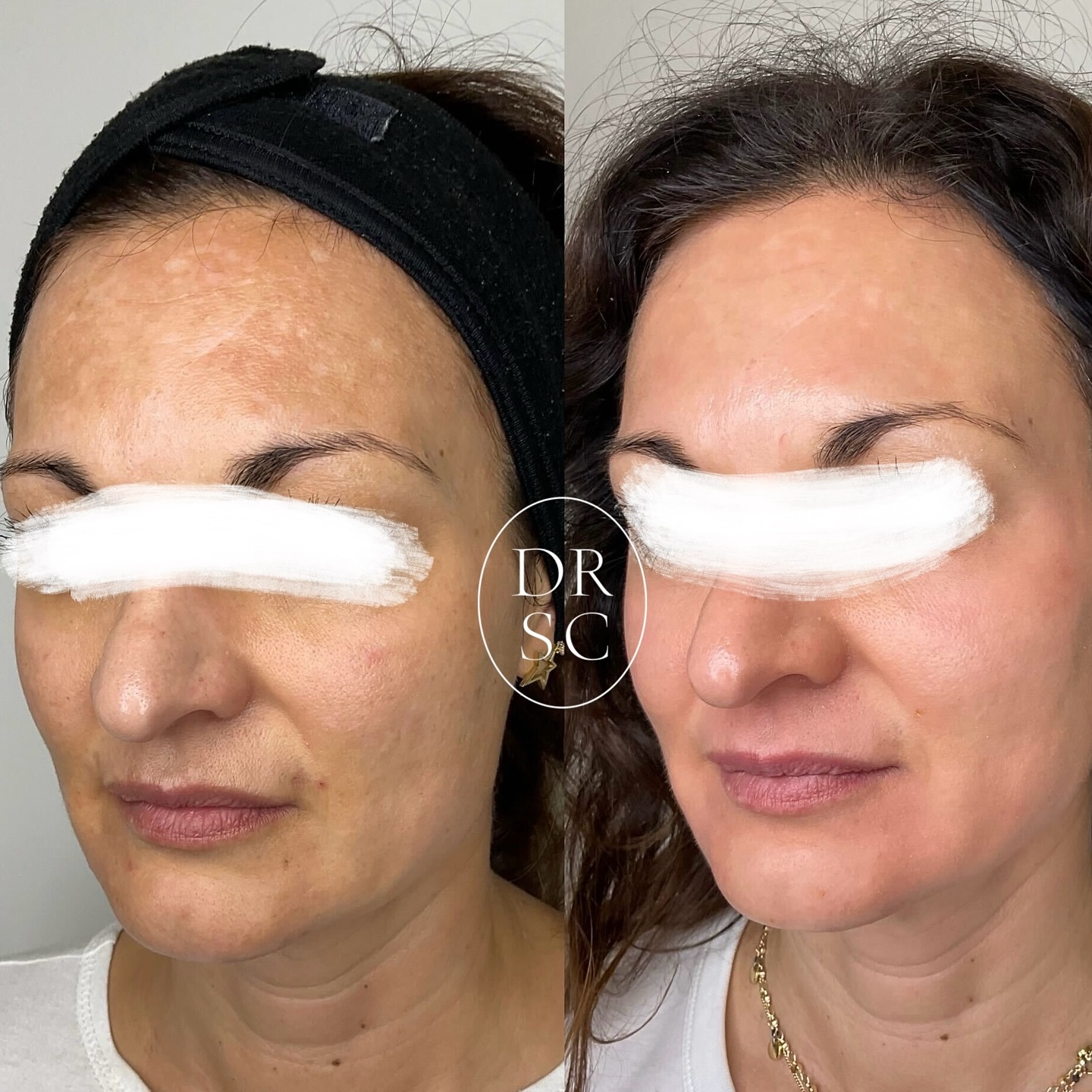 Clarity and Confidence: Melasma Therapy @drserenacardoso.
Melasma looks like blotchy, brown facial pigmentation that can affect your quality of life.
My Top Tips?
1. Avoid the sun and apply a teaspoon of tinted SPF 50 to your face twice daily, year round, even in this winter rain! If you’re not doing this step, the next steps don’t count.
2. Home regimes may include a combination of hydroquinone, retinoid and topical corticosteroids for short periods (a serious prescription that is effective but may have side effects), cycled with other non-hydroquinone pigment blockers (non-prescription cosmeceuticals).
3. Oral tranexamic acid (prescription) for select patients.
4. In-office facials incorporating low strength, pigment specific chemical peels and in expert hands, a combination of nano-needling and lasers.
#pigmentation #brownspots #marks #lasers #melasma #skinbrightening #glow #beauty #capetowndoctor