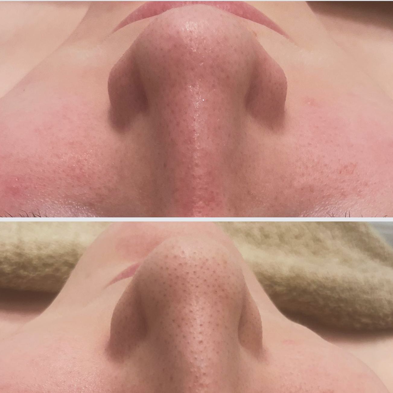Blackhead bye 👋 Caci Ultra-sonic peeling @caci_beauty …….rapidly vibrates on the skin (27,000 times per second) to gently exfoliate and revitalise. The vibrations draw skin impurities to the surface and dislodge dead skin cells revealing a healthy, glowing complexion 👌#skin#ckearskin#chesterfield#beautiquebarlborough @