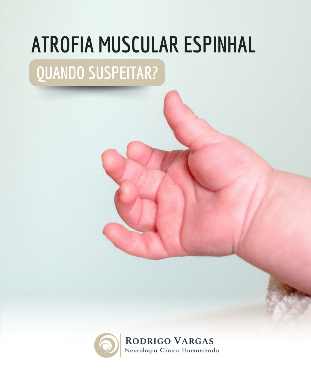 A Atrofia Muscular Espinhal (AME) é uma doença genética que afeta os neurônios motores, responsáveis por controlar os movimentos musculares. Essa condição leva à fraqueza e atrofia progressiva dos músculos, variando em gravidade de acordo com o tipo da doença, que vai do 0 ao 4, dependendo da idade de início e da funcionalidade residual.
O quadro clínico pode incluir fraqueza muscular simétrica, hipotonia (músculos flácidos), dificuldade para engolir, respirar e sustentar a cabeça, além de atraso motor, como dificuldade em sentar, ficar em pé ou caminhar, dependendo da idade de início. Nos casos graves (tipos 0 e 1), os sintomas podem aparecer desde o nascimento ou primeiros meses de vida, enquanto nos tipos mais leves, a fraqueza pode surgir na infância, adolescência ou idade adulta.
É fundamental procurar ajuda médica quando um bebê ou criança apresenta atraso no desenvolvimento motor, fraqueza progressiva, dificuldade para respirar ou engolir, ou sinais de hipotonia. O diagnóstico precoce é crucial para iniciar tratamentos disponíveis, como a terapia gênica, que pode retardar a progressão da doença e melhorar a qualidade de vida.
Dr. Rodrigo R. N. Vargas
Médico Neurologista e Neuropediatra
Título de Especialista em Neurologia pela Academia Brasileira de Neurologia (ABN/AMB)
Título de Especilista em Neuropediatria pela Sociedade Brasileira de Pediatria e Academia Brasileira de Neurologia (SBP/ABN/AMB)
Membro Titular da Academia Brasileira de Neurologia (ABN)
Membro Titular da Sociedade Brasileira de Neurologia Infantil (SBNI)
CRM-GO 15286 / RQE 9716 / RQE 18012
#AME
#AtrofiaMuscularEspinhal
#DesenvolvimentoMotor
#PaisAtentos
#Neuropediatria
#OesteGoiano
#rodrigovargasneuro
#HospitalSãoPaulo