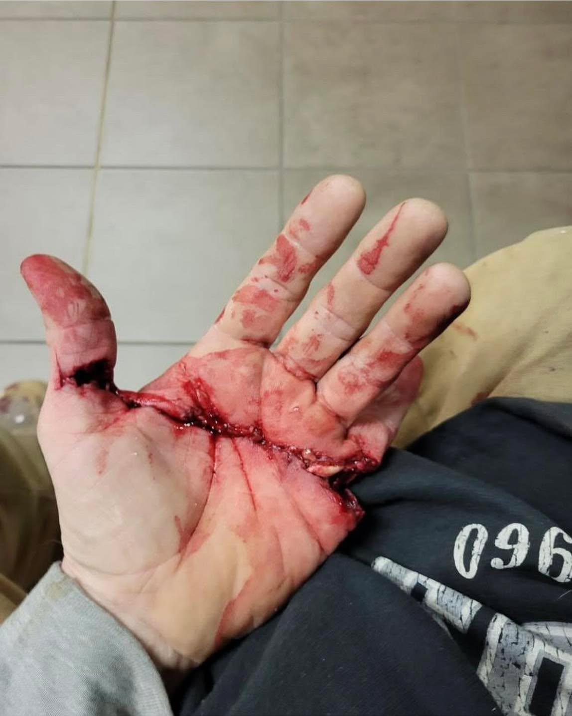 Fire/EMS, how would you handle?
Table saw vs hand!
This patient accidentally got too close to a table saw, resulting in a deep laceration through the pinky and thumb.
The injury extends through the tendons and veins, with the flexor digitorum superficialis tendon clearly severed. Notice the tendon bulging out of the wound, indicating a complete tear of the tendon.
The flexor digitorum superficialis tendon (FDS) is one of the key tendons responsible for flexion in the fingers. Each finger, except the thumb, has an FDS tendon that allows flexion at the proximal interphalangeal (PIP) joint, which is crucial for gripping and fine motor tasks. Without proper function of this tendon, the patient would have difficulty with any activity requiring finger flexion, such as grasping objects or making a
In this case the pinky (5th digit) was severed from the table saw. The FDS tendon to the pinky is responsible for flexing the PIP joint. After the tendon is torn, the patient basically loses the ability to bend this joint, leading to reduced or incomplete flexion of the pinky.
In the case of the thumb, while the FDS tendon doesn't exist similar tunt, oh flexumo lexin. us endon s tendons are
severed, there would be difficulty flexing the thumb.
This patient went through tendon and vascular repair surgeries and the last photo shows the follow-up after one year of rehabilitation. He re-gained tendon integrity and most of its function back!
Credit: @medicaltalks
#tactical #save #human #trauma #training #teaching #learning #community #medical #bethechange #life #vaemstg #emt #firefighter #fire #paramedic #ems #reels #school #education #virginia #group #youtube #knowledge #instagram #trending #facebook