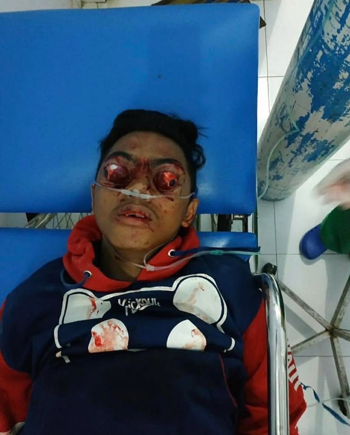 Fire/EMS, what’s your treatment??
Did you know your eyes can be pushed out of the sockets!?
This is a case of globe luxation that was caused by trauma (motorcycle accident). Globe luxation is when the eyeball either partially or completely prolapses or falls out of the orbital socket, but can still be attached to the brain by the optic nerve! The function of the eye and cosmetic aesthetic varies depending on the extent of the injury.
Credit: @mrs_angemi
#tactical #save #human #trauma #training #teaching #learning #community #medical #bethechange #life #vaemstg #emt #firefighter #fire #paramedic #ems #reels #school #education #virginia #group #youtube #knowledge #instagram #trending #facebook