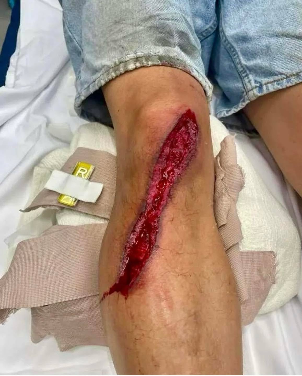 Hunting Season is coming…be safe!
Leg after a .500 magnum accidental discharge grazed the patients knee and shin. Fortunately the wound looks superficial.
Remember to always keep safe when handling firearms!
Credit:@medicaltalks
#tactical #save #human #trauma #training #teaching #learning #community #medical #bethechange #life #vaemstg #emt #firefighter #fire #paramedic #ems #reels #school #education #virginia #group #youtube #knowledge #instagram #trending #facebook