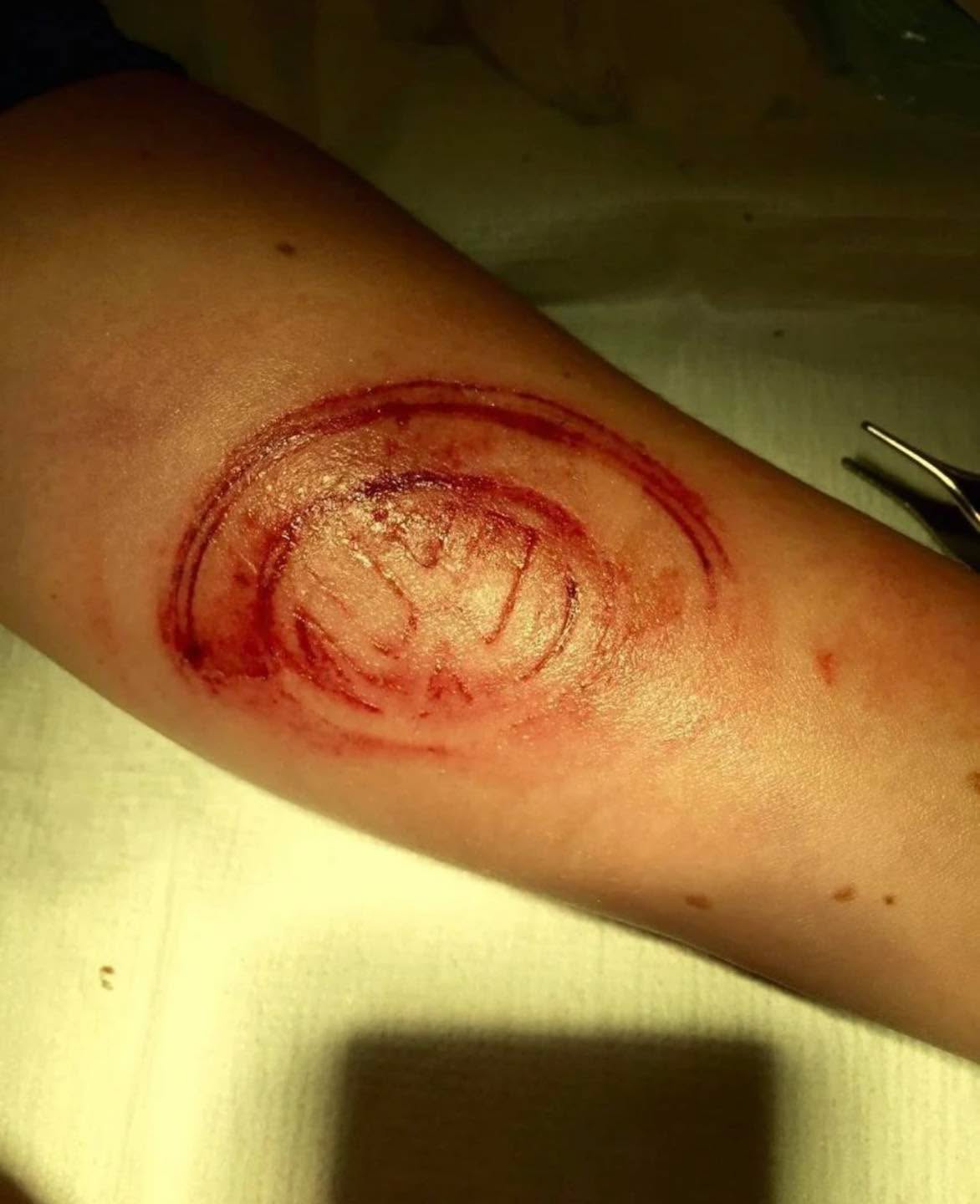 Car crash resulted in airbag inflation and hitting the driver with a steering wheel cover, leaving the logo of the car imprinted in his arm!
Can you guess the car brand?
Airbags have been fitted into cars for nearly 50 years. During this time there have been numerous reports of injuries directly attributable to airbags. While accepting that these injuries occur, most (up to 96%) are comparatively minor.
There is no doubting the overwhelming evidence that airbags are effective at saving lives and preventing serious injury, particularly if used with a well fitted three point seat belt, and any injury attributable to their use must be seen in light of this knowledge.
Credit: medicalpedia
#tactical #save #human #trauma #training #teaching #learning #community #medical #bethechange #life #vaemstg #emt #firefighter #fire #paramedic #ems #reels #school #education #virginia #group #youtube #knowledge #instagram #trending #facebook