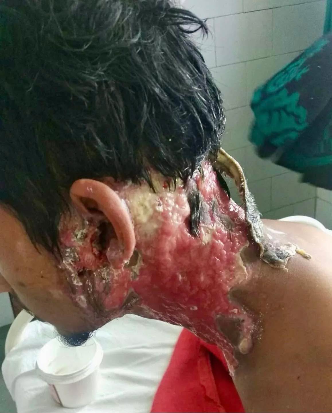 We just talked about this in our National Registry of Emergency Medical Technicians (NREMT) with Dinwiddie Fire and EMS in Dinwiddie, VA. and wanted to share…
Can you guess what might have caused this severe skin injury?
Correct answer —
🟰 Chemical burn
A patient with an extreme acid burn all over his neck region!!
A chemical burn occurs when living tissue is exposed to a corrosive substance (such as a strong acid, base or oxidizer) or a cytotoxic agent (such as mustard gas, lewisite or arsine).
All may cause extensive tissue damage.
Both acids and bases can be defined as caustics, which cause significant tissue damage on contact. The strength of an acid is defined by how easily it gives up the proton; the strength of a base is determined by how avidly it binds the proton.
Most acids produce a coagulation necrosis by denaturing proteins, forming a coagulum (eg, eschar) that limits the penetration of the acid. Bases typically produce a more severe injury known as liquefaction necrosis. This involves denaturing of proteins as well as saponification of fats, which does not limit tissue penetration. Hydrofluoric acid is somewhat different from other acids in that it produces a liquefaction necrosis.
The severity of the burn is related to a number of factors, including the pH of the agent, the concentration of the agent, the length of the contact time, the volume of the offending agent, and the physical form of the agent. The ingestion of solid pellets of alkaline substances results in prolonged contact time in the stomach, thus, more severe burns. In addition, concentrated forms of some acids and bases generate significant heat when diluted or neutralized, resulting in thermal and caustic injury.
The long-term effect of caustic dermal burns is scarring, and, depending on the site of the burn, scarring can be significant.
Credit:medicaltalks
#tactical #save #human #trauma #training #teaching #learning #community #medical #bethechange #life #vaemstg #emt #firefighter #fire #paramedic #ems #reels #school #education #virginia #group #youtube #knowledge #instagram #trending #facebook