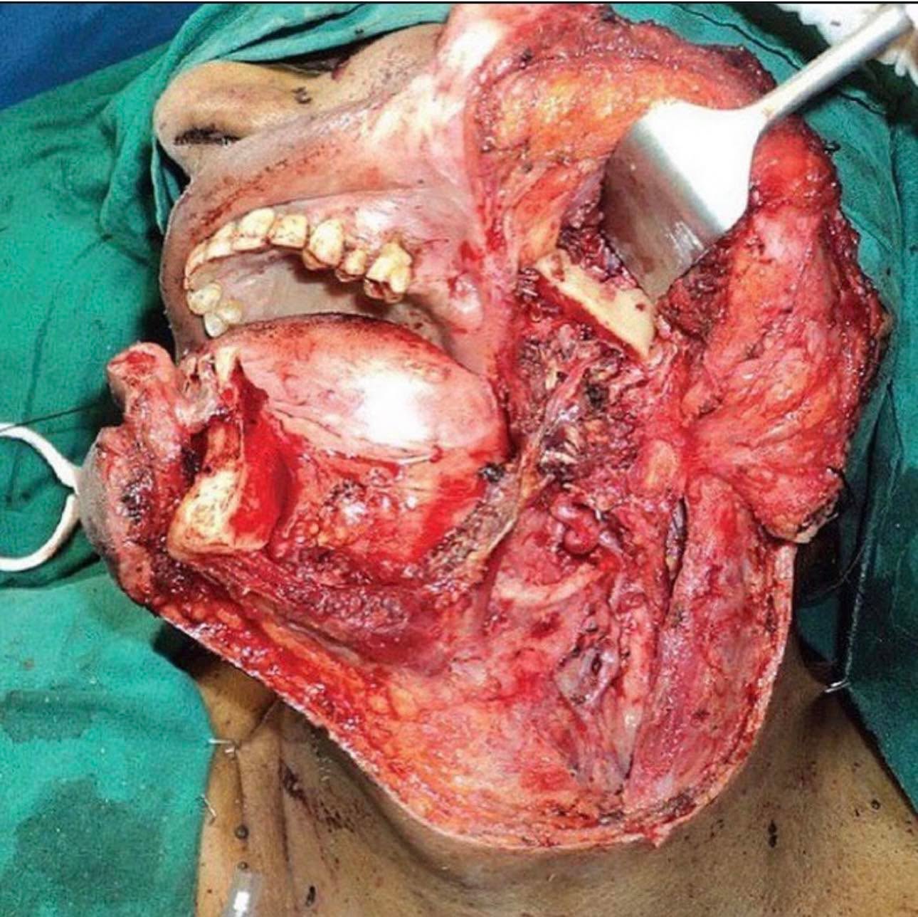 A 64 year old gentleman with a post radiation recurrent squamous carcinoma of the left lower alveolus was posted for composite resection and reconstruction with fibula free flap.
Mandibular defects may result from trauma, inflammatory disease and benign or malignant tumours. Mastication, speech and facial aesthetics are often severely compromised without reconstruction.
The goal of mandibular reconstruction is to restore facial form and function.
Credit@hidocdr
#tactical #save #human #trauma #training #teaching #learning #community #medical #bethechange #life #vaemstg #emt #firefighter #fire #paramedic #ems #reels #school #education #virginia #group #youtube #knowledge #instagram #trending #facebook