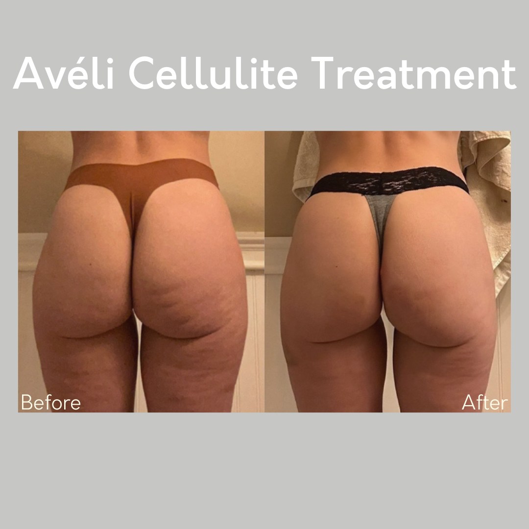 ✨ Real Results, Real Confidence! ✨
Tired of stubborn cellulite? Now offering Aveli, a cellulite treatment at Cincinnati Plastic Surgery! This is the breakthrough treatment you’ve been waiting for! This minimally invasive, FDA-cleared procedure precisely targets and releases the fibrous bands causing dimples—leaving you with smoother, firmer skin in just one session! 💖
✅ Long-lasting results
✅ Minimally invasive, no major downtime
✅ Clinically proven to reduce cellulite
💃 Confidence in every angle starts here! Book your consultation today and let’s get you summer-ready! ☀
⏱ Time- 1-2 Hours
🩹 Recovery- 2-5 Days
💳 Total cost- $2,500-$3,500
📍 Cincinnati Plastic Surgery
📅 Book Your Free Consultation Today!
#AveliCelluliteTreatment #SmoothSkin #CelluliteFree #BodyConfidence #CincinnatiPlasticSurgery #PlasticSurgery