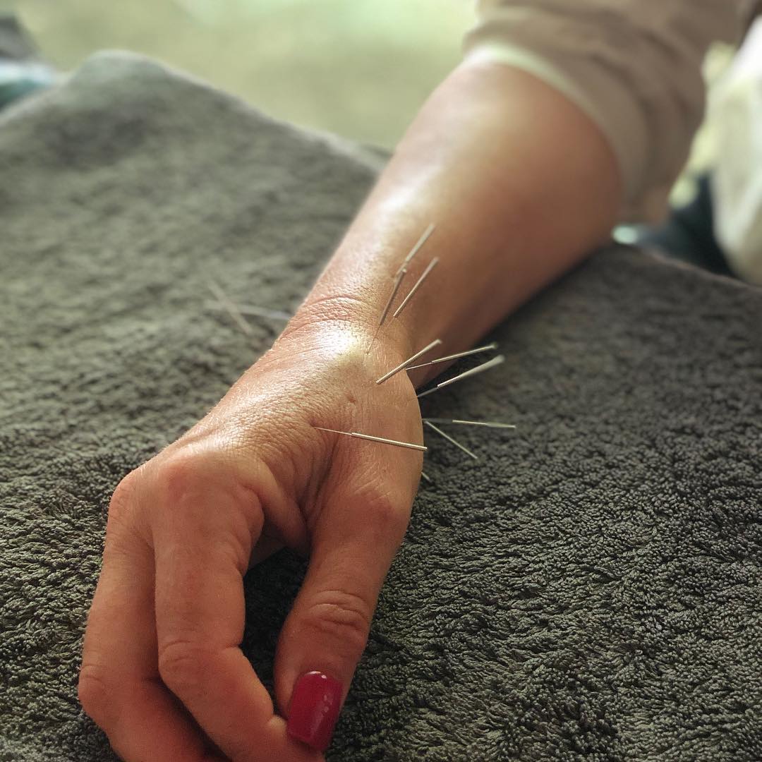 💬 Struggling with wrist pain? Let’s chat!
De Quervain’s Tenosynovitis is an overuse injury affecting the extensor pollicis brevis & longus tendons, causing pain & swelling on the radial side of the wrist. Everyday movements like hammering, wringing out clothes, holding a baby, or excessive phone use can aggravate it.
How Acupuncture Can Help
In Traditional Chinese Medicine (TCM), this condition is linked to the Lung & Large Intestine meridians, often caused by Qi stagnation, dampness, and blood stasis. Acupuncture can reduce inflammation, relieve pain, and restore mobility by improving circulation and breaking up stagnation.
My Approach:
🔹 LI5 (Yangxi), LU9 (Taiyuan) – Local wrist pain relief, promotes Qi & blood flow
🔹 LI6 (Pianli), LU7 (Lieque) – Clears channel obstructions, reduces swelling
🔹 LI4 (Hegu), SJ5 (Waiguan) – Opens the wrist area, reduces pain & tension
🔹 LU10 (Yuji), LU11 (Shaoshang) – Clears heat, promotes healing
🔹 LI1 (Shangyang), LI2 (Erjian) – Bleeding technique for stubborn cases
🔹 SI3 (Houxi), Ba Xie points – Treats the hand as a whole, improves mobility
✔ Zheng Gui Shui Liniment topically to reduce inflammation & promote circulation
✔ Electro-Acupuncture at key points
If wrist pain is limiting your daily life, acupuncture could be the missing piece in your recovery!