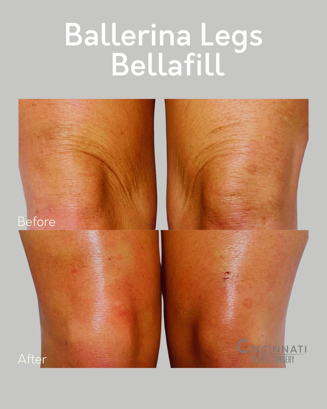 💃 Ballerina Legs with Bellafill 💃
Check out this stunning before & after! Bellafill helps smooth and sculpt for that toned, elegant "ballerina leg" look—perfect for enhancing contours and minimizing dimples. Long-lasting results, graceful confidence.
📞 513-469-0300
🌐 www.CincinnatiPlasticSurgery.com
#BallerinaLegs #BellafillResults #LegRejuvenation #CincinnatiPlasticSurgery #BeforeAndAfter #SmoothLegs #GraceInEveryStep #Medspa