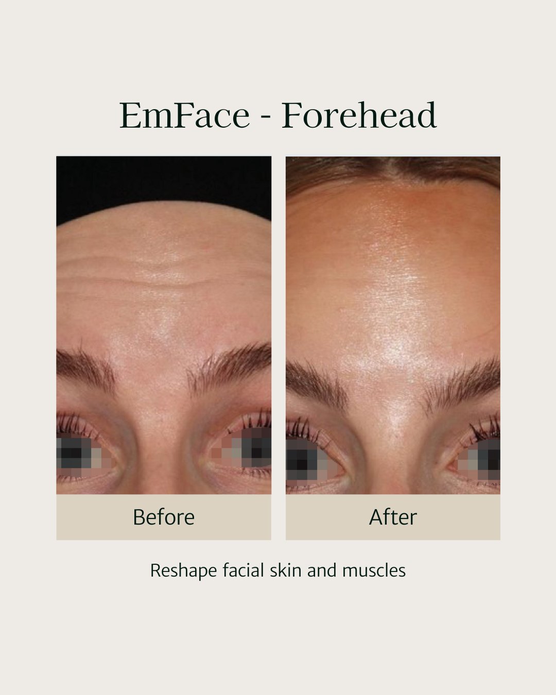 Check out this stunning result with EmFace. Smoother skin, fewer wrinkles, and a natural refreshed look!