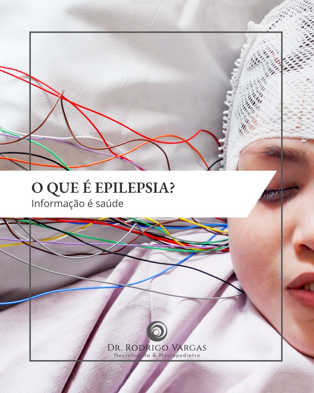 A epilepsia é um distúrbio neurológico crônico caracterizado pela predisposição a crises epilépticas espontâneas e recorrentes, que resultam de descargas elétricas anormais e síncronas no cérebro. Essas crises podem variar amplamente em tipo, duração e gravidade, dependendo das áreas cerebrais afetadas.
As crises epilépticas são classificadas em dois grandes grupos: crises focais, que começam em uma área específica do cérebro, e crises generalizadas, que envolvem ambos os hemisférios cerebrais desde o início. Os sintomas podem incluir a perda de consciência, movimentos involuntários, alterações sensoriais, comportamentais ou emocionais.
A epilepsia pode ser causada por diferentes fatores, como lesões cerebrais (trauma, AVC, infecções ou tumores), predisposição genética, malformações congênitas ou condições metabólicas. Em muitos casos, no entanto, a causa permanece desconhecida.
O diagnóstico é feito com base no histórico clínico, exames neurológicos, eletroencefalograma (EEG) e neuroimagem (como ressonância magnética). O tratamento inclui medicamentos antiepilépticos, e em alguns casos, cirurgia, dieta cetogênica ou dispositivos de estimulação nervosa.
Com tratamento adequado, a maioria das pessoas com epilepsia pode controlar as crises e levar uma vida normal, mas o manejo deve ser contínuo e adaptado às necessidades individuais.
Dr. Rodrigo R. N. Vargas
Médico Neurologista e Neuropediatra
Título de Especialista em Neurologia pela Academia Brasileira de Neurologia (ABN/AMB)
Título de Especilista em Neuropediatria pela Sociedade Brasileira de Pediatria e Academia Brasileira de Neurologia (SBP/ABN/AMB)
Membro Titular da Academia Brasileira de Neurologia (ABN)
Membro Titular da Sociedade Brasileira de Neurologia Infantil (SBNI)
CRM-GO 15286 / RQE 9716 / RQE 18012
#Epilepsia
#PaisAtentos
#Neuropediatria
#OesteGoiano
#rodrigovargasneuro
#HospitalSãoPaulo
#Epilepsia #Neurologia #SaúdeDoCérebro #Conscientização #Convulsão #Tratamento #InformaçãoÉSaúde #DrRodrigoVargas #Neurociência