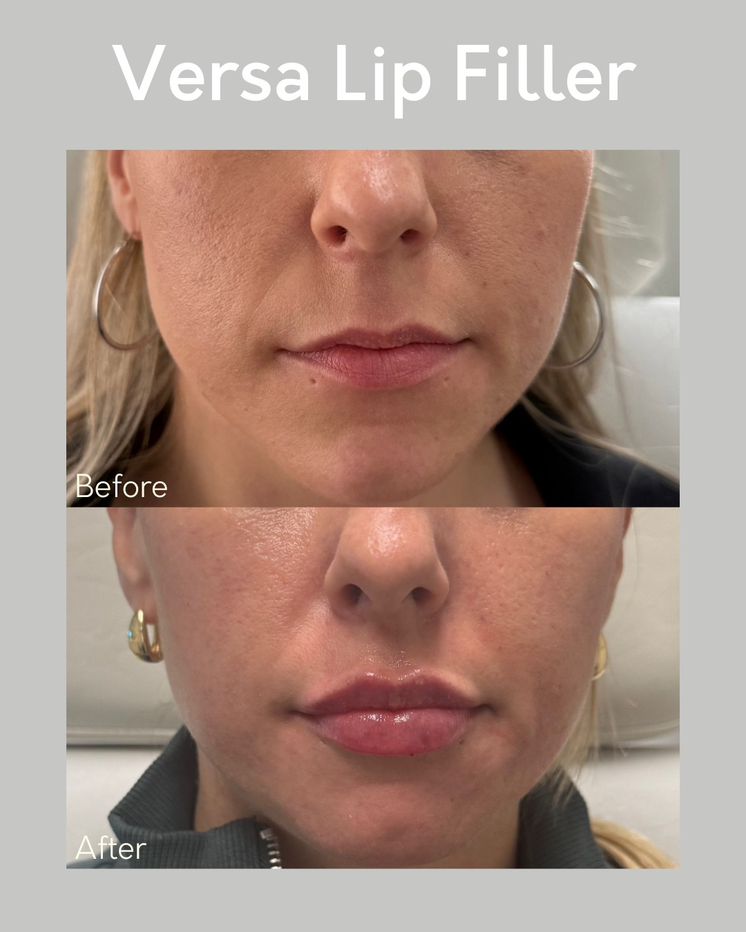 💋 Before & After: Versa Lip Filler 💋
Say hello to soft, natural-looking volume! Our Versa Lip Filler enhances your shape, defines your borders, and restores youthful plumpness — all while keeping your lips smooth and balanced. 👄✨
Whether you’re going for subtle hydration or a fuller pout, Versa delivers beautiful, long-lasting results with minimal swelling and downtime.
📍 Cincinnati Plastic Surgery
📅 Book your lip filler consultation today!
📞 513-469-0300
🌐 www.CincinnatiPlasticSurgery.com
#VersaLips #LipFillerCincinnati #CincinnatiPlasticSurgery #BeforeAndAfter #MedspaCincinnati #LipGoals #NaturalEnhancement #CincinnatiAesthetics #PlasticSurgery