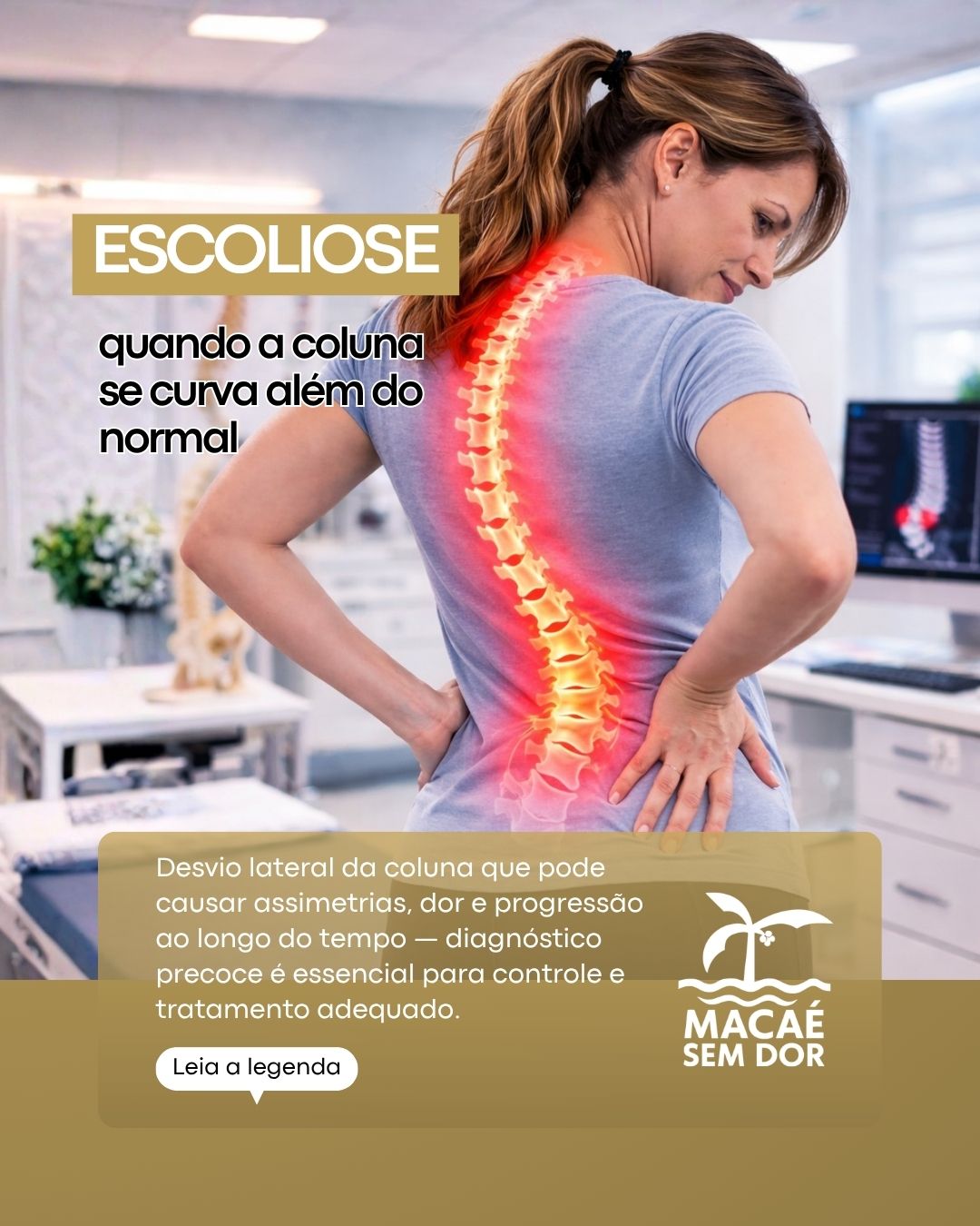 A escoliose é um desvio lateral da coluna que pode evoluir de forma silenciosa — muitas vezes sem dor nas fases iniciais.
Sinais como ombros desalinhados, assimetria na cintura ou um lado das costas mais elevado podem indicar a presença da curvatura. Com o tempo, a escoliose pode causar desconforto, alteração postural e, em casos mais avançados, impacto funcional e estético.
O diagnóstico precoce é fundamental para acompanhar a evolução e definir o melhor tratamento — que pode incluir observação, fisioterapia específica, uso de colete ou, em situações mais complexas, abordagem cirúrgica.
Quanto antes identificar, maiores são as chances de controle.
Observe os sinais. Cuide da sua coluna.
#Escoliose #ColunaVertebral #Postura #SaúdeDaColuna #Ortopedia #QualidadeDeVida