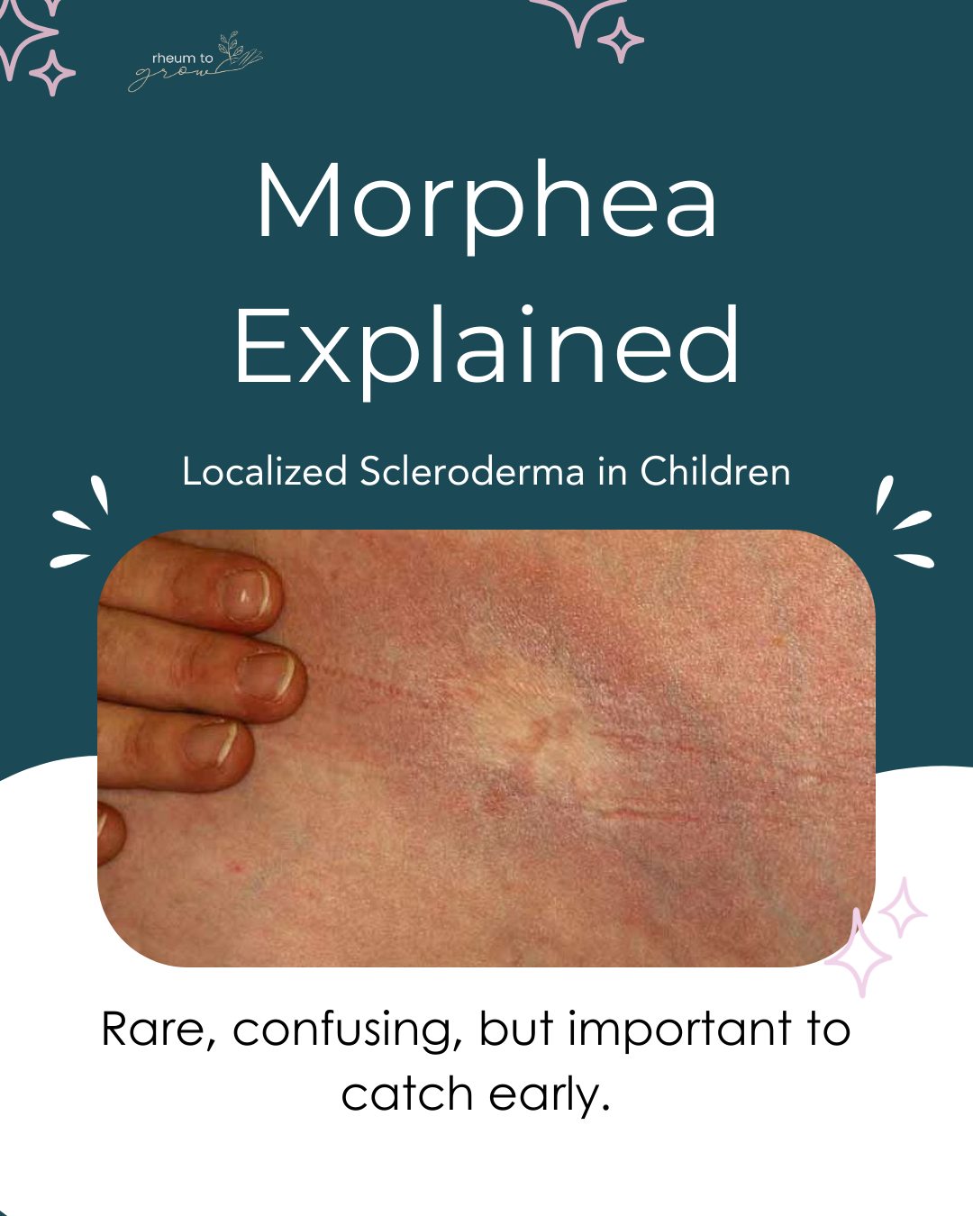 Morphea explained: localized scleroderma in children 💙
Morphea, also known as localized scleroderma, is a rare autoimmune condition that causes patches of thickened, discolored skin. Unlike systemic scleroderma, morphea usually affects the skin and sometimes the tissue underneath, but it typically spares the internal organs.
There are different types of morphea:
✨ Plaque (circumscribed) morphea — single or multiple raised patches
✨ Linear morphea — streaks often on the arms, legs, or face
✨ Generalized morphea — larger areas of skin involvement
Early recognition matters. ⏰ Morphea can impact growth, joint movement, or appearance if left untreated, which is why timely evaluation is so important.
👉 Save this post to share with another parent.
🤍 If you want clarity, we’re here to help families get answers early.
💬 Comment ME to book a call with Dr. Singla.
#autoimmunewellness #chronicillnesscommunity #houstontexas #texas #pediatricrheumatologist
👉Comment the word STACK to receive the link to download our free guide: The Pyramid Stack: A step by step guide to level up your child’s autoimmune care.
Photos credit: Reproduced with permission from ©DermNet New Zealand and © Raimo Suhonen www.dermnetnz.org 2023. And the Journal of Pediatrics.
