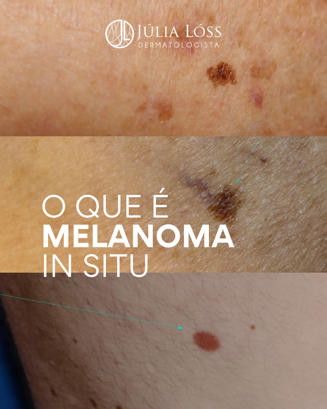 O tempo é definidor no diagnóstico do melanoma. Não é drama nem exagero, é literalmente determinante para o aprofundamento do tumor.
Quando ele ainda está in situ, a doença está superficial. A partir do momento que invade, o cenário já exige outro nível de atenção, investigação e estratégia.
Não é só sobre o nome do diagnóstico. É sobre até onde aquela lesão já foi.
Por isso, acompanhar a pele com regularidade não é excesso de cuidado. É o que mantém o problema simples antes de se tornar complexo.
Dra. Júlia Lóss - Médica Dermatologia Oncológica
CRM 5201085638 RQE 34041
#melanoma #melanomainsitu #fotofinder #dermatoscopia #mapeamentocorporal