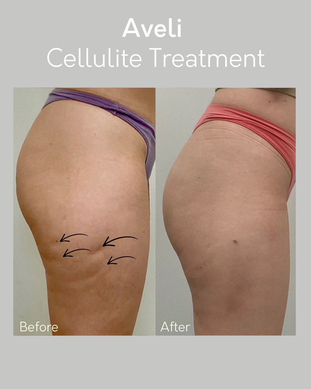 Smooth skin just got even better. ✨
This Aveli before & after shows real improvement in cellulite by treating the root cause—not just the surface. By releasing the fibrous bands beneath the skin, Aveli creates smoother, more even-looking results that last.
Now offering $500 OFF Aveli treatments for a limited time.
If you’ve been thinking about finally addressing cellulite, this is your sign.
Give us a call or visit our website to schedule your complimentary consultation today!
📲 513-469-0300
🌐 www.CincinnatiPlasticSurgery.com