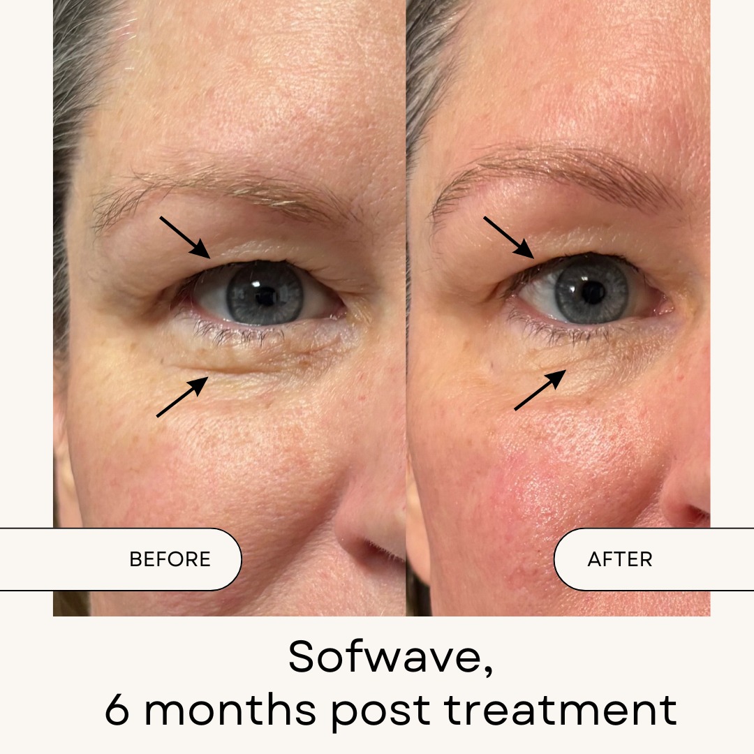 Lifting and smoothing go hand in hand with SOFWAVE!✨
At 6 months post-treatment, we’re seeing a beautifully lifted, more youthful eye area. NO surgery, NO downtime, NO interruption to your routine.
For anyone exploring ways to refresh their look without going all-in, this is your sign.🛑