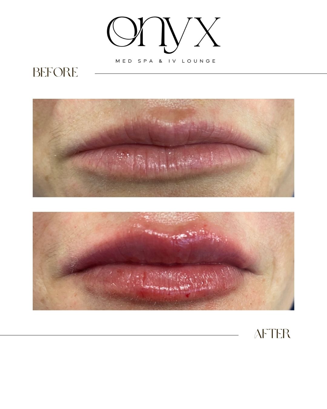 Soft volume, subtle balance. It is the kind of result that speaks for itself. ❤️🔥
This look was all about enhancing what’s already there. Refining shape, restoring symmetry, and adding just the right amount of fullness without ever overdoing it.
Effortless, natural, and tailored to her features.
#filler #lipinjections #lipfiller #cosmetics #fillers #lips #cosmeticinjectables #injectables #medicalspa #medspa #lipfillers #skin #antiaging #antiwrinkleinjections #medicalaesthetics #medispa #loveyourlips #aesthetics #dermalfiller #injections #wrinkles #onyxmedspa #arinjections #arkansasmedspa