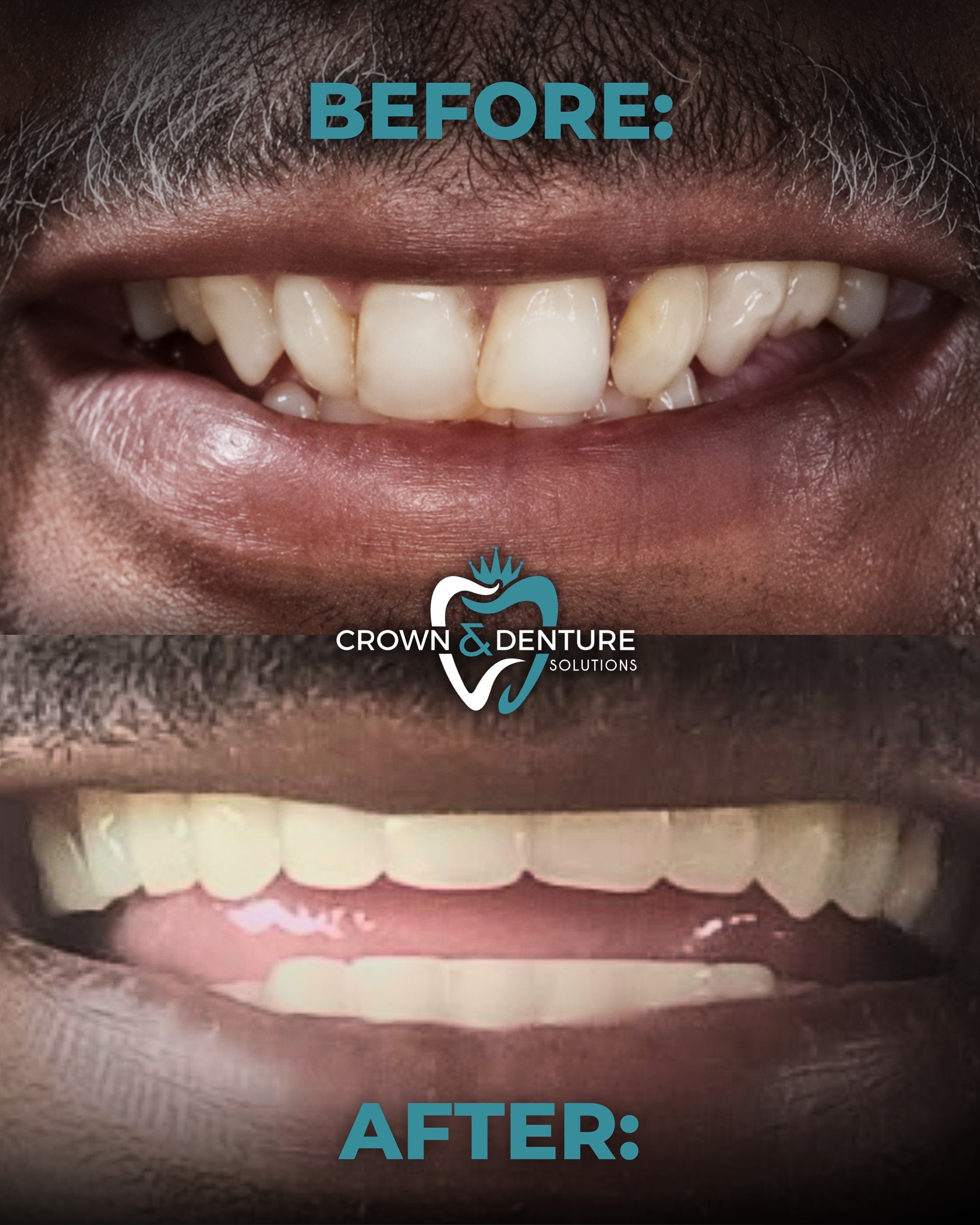 We love a good smile transformation around here! 😊
There’s nothing better than seeing someone go from covering their smile to showing it off with confidence again. Every denture we make is customized in our on-site lab and adjusted by hand to make sure it looks natural, feels comfortable, and fits the way it should.
This is more than just a before and after. It’s someone feeling like themselves again.
📞 Call 318-232-4404 to schedule your free X-ray and exam.
#SmileTransformation #BeforeAndAfter #CustomDentures #OnSiteLab #SmileWithConfidence