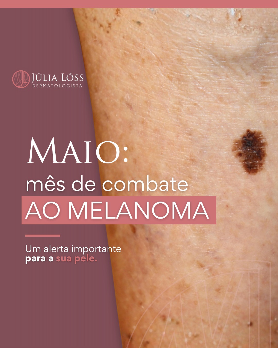 Maio é o mês internacional de combate ao melanoma.
Entenda um pouco mais sobre esse tipo de câncer de pele e os fatores de risco.
O diagnóstico precoce salva vidas!
Dra. Júlia Lóss - Dermatologia Oncológica
CRM 5201085638 RQE 34041
#melanoma #dermatoscopia #maiomelanoma #cancerdepele
