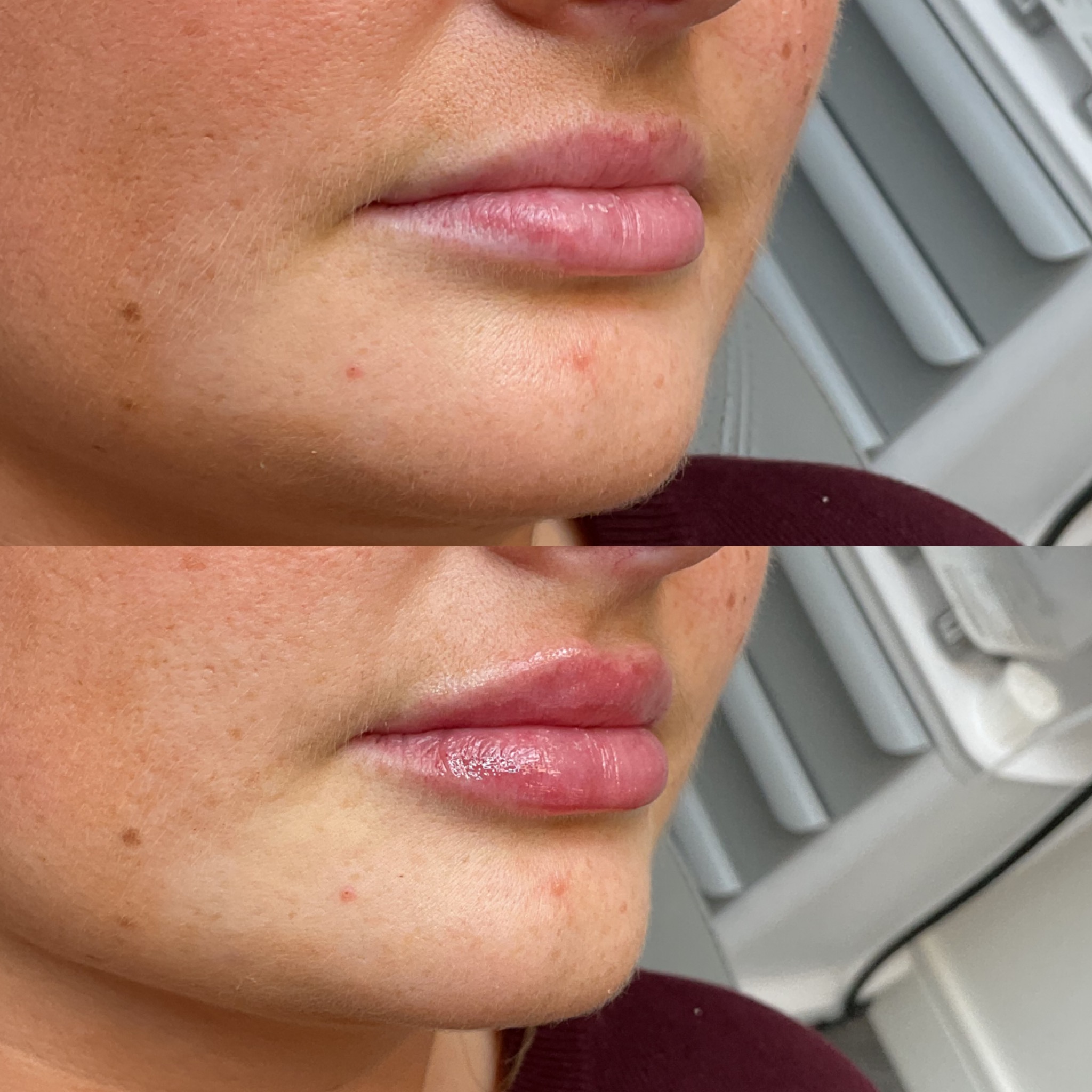 0.5ml Lip Enhancement 👄
A refined treatment to add gentle volume, definition, and hydration while keeping results soft and natural-looking.
💉 Treatment: 0.5ml
💷 Price: £145
⏱ Recovery: 24–48 hours
⏳ Results: 6–12 months
✔️ No edited images
✔️ Performed by Nurse Prescriber Geraldine Malone
✔️ Save Face Registered Clinic
📅 Book now:
https://www.geraldinemalone.co.uk/book-appointment
📞 024 7792 1812
📧 geraldinemaloneaesthetics@outlook.com