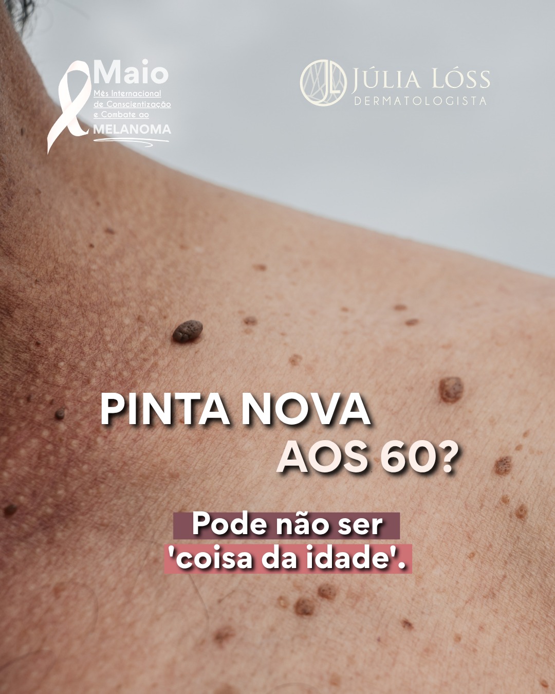 “Ah, apareceu agora… deve ser só uma manchinha da idade.”
Esse pensamento atrasa diagnósticos importantes.
Lesões pigmentadas que surgem na vida adulta merecem atenção e avaliação. Nem toda pinta nova é melanoma, mas toda lesão nova precisa ser examinada com cuidado.
A dermatoscopia permite analisar estruturas invisíveis a olho nu e identificar sinais precoces de malignidade.
No melanoma, o tempo faz diferença no prognóstico. Diagnóstico precoce salva vidas.
Dra. Júlia Lóss
Médica Dermatologiasta Oncológica
CRM 5201085638 • RQE 34041
#melanoma #Dermatoscopia #fotofinder #DermatologiaOncologica #maiomelanoma