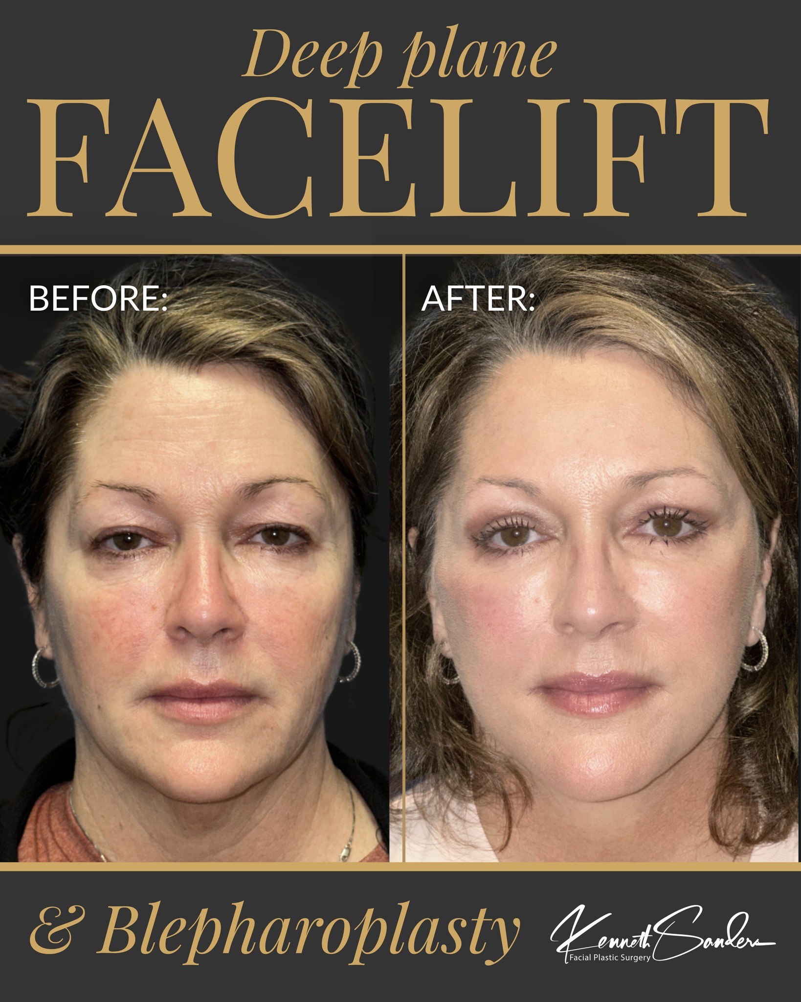 When facial rejuvenation is done well, people usually can’t tell what changed. They just see someone who looks refreshed, rested, and confident again. ❤️
This patient’s transformation included a Deep Plane Facelift and Upper and Lower Blepharoplasty. Treating all four eyelids softens the heaviness around the eyes, giving a more “happy” or “awake” look. While the Deep Plane Facelift restores the overall appearance giving a smoother, more contoured look throughout the face and jawline.
With over 25 years of experience in facial plastic surgery, Dr. Kenneth Sanders combines surgical precision with a refined, artistic approach to create results that never look overdone. Every detail is carefully considered, from facial balance and natural movement to the way light reflects across the contours of the face.
If you’ve been thinking about facial rejuvenation, your consultation is the first step toward understanding what’s possible for you. A personalized treatment plan can make all the difference in achieving results that feel natural, balanced, and beautifully tailored to your features.
📞 Call (318) 698-8711 to schedule your consultation with Dr. Sanders.
#DeepPlaneFacelift #Blepharoplasty #FacialRejuvenation #FacialPlasticSurgery #NaturalResults
