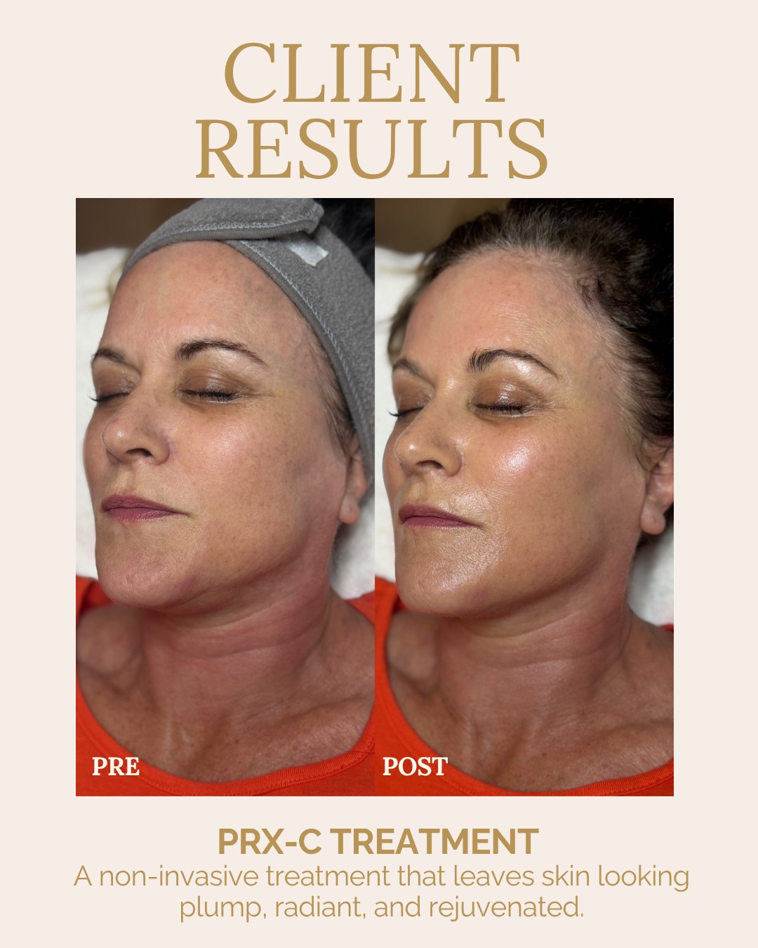 The results speak for themselves:
✨ Visibly tighter skin
✨ Softer fine lines
✨ Refined pores
✨ A brighter, more radiant complexion
PRX is one of our favorite treatments for clients looking to improve overall skin quality and achieve a healthy, youthful glow. Interested in results like this? Click the link in our bio or visit thegrovespa.com for more details! 🤍